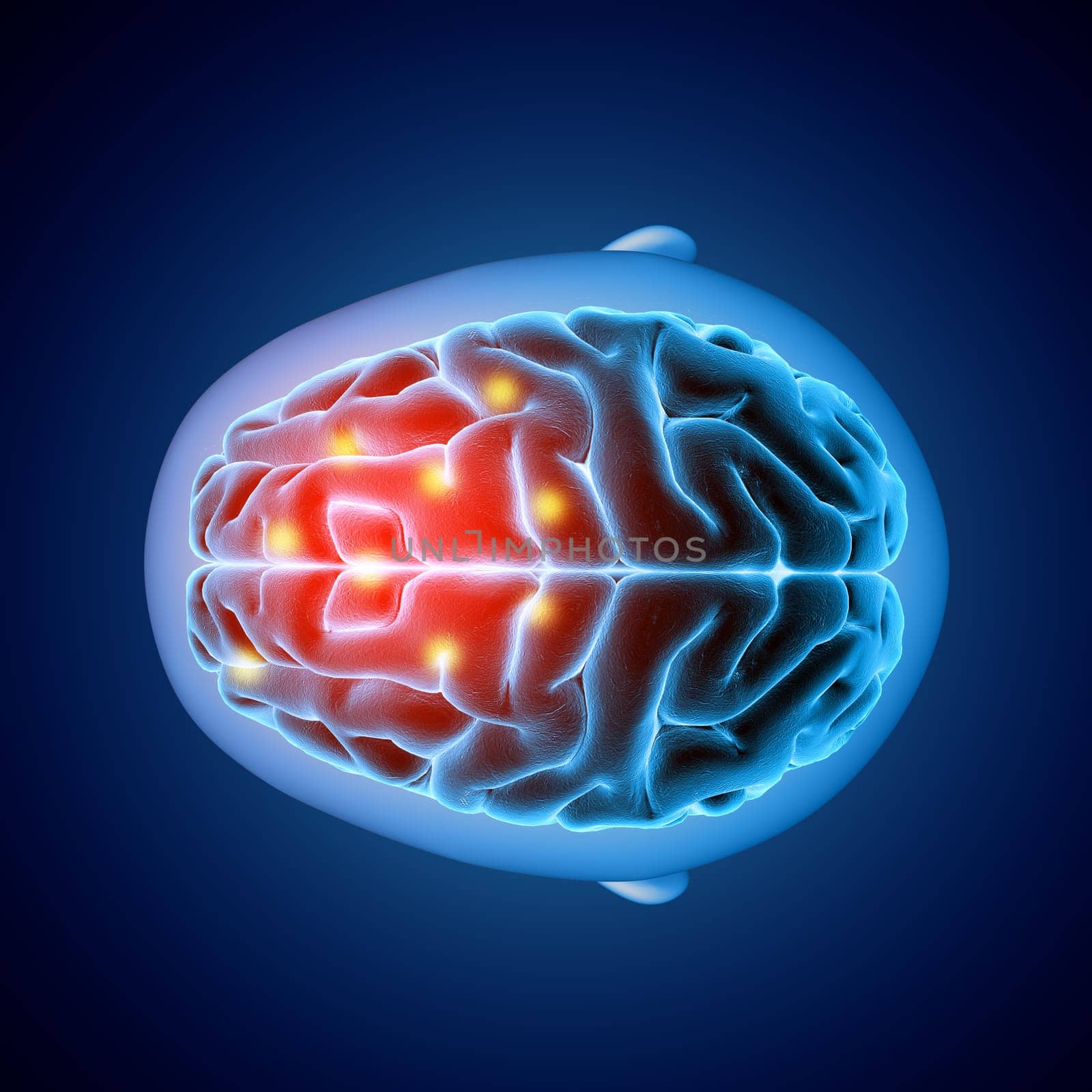 3D render of a medical image showing top view of a brain with parts highlighted