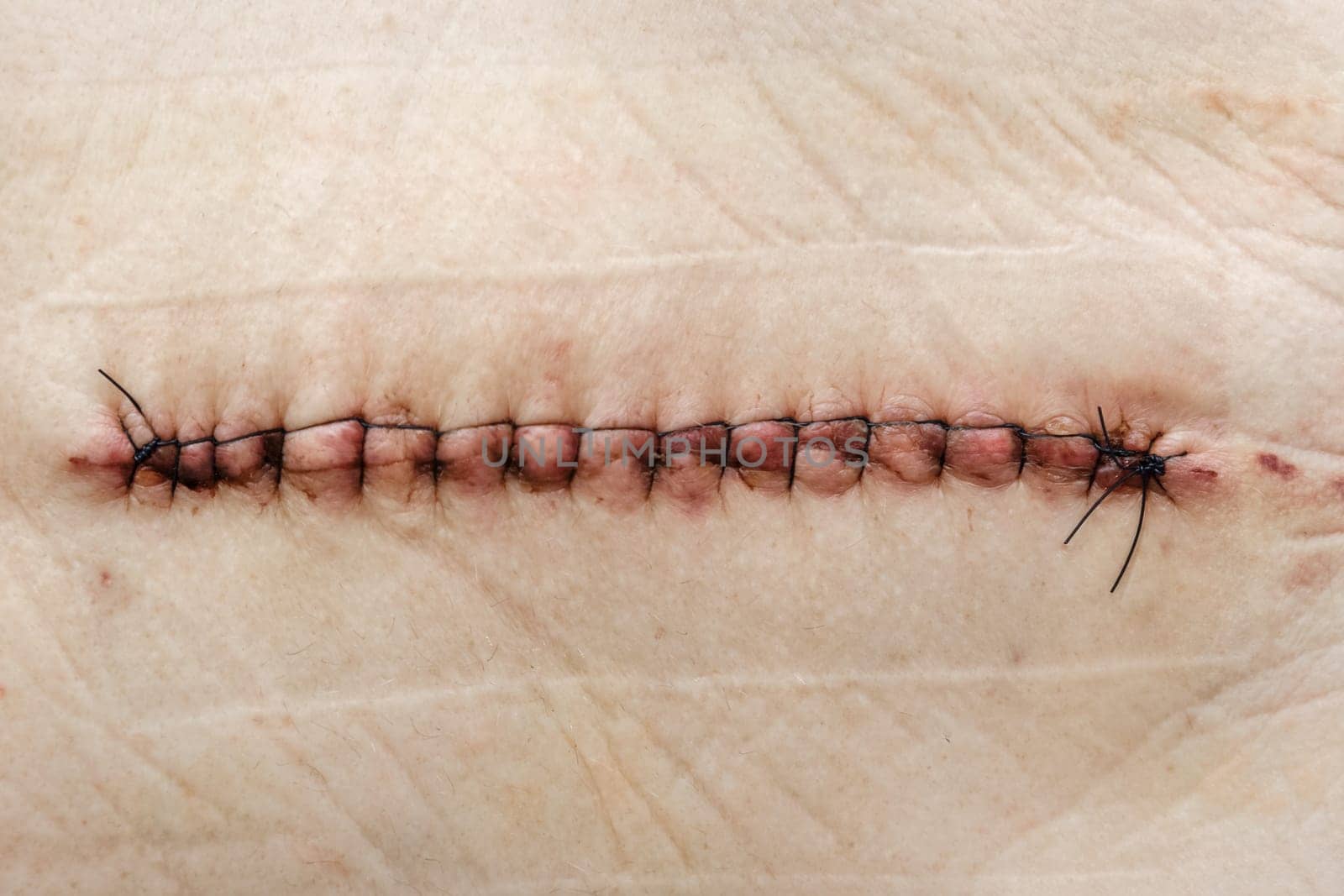 SuPostoperative healing suture on human skin with black medical threads rgery on the hip. Postoperative suture on the skin with iodine. Un Stitched up skin after an operation