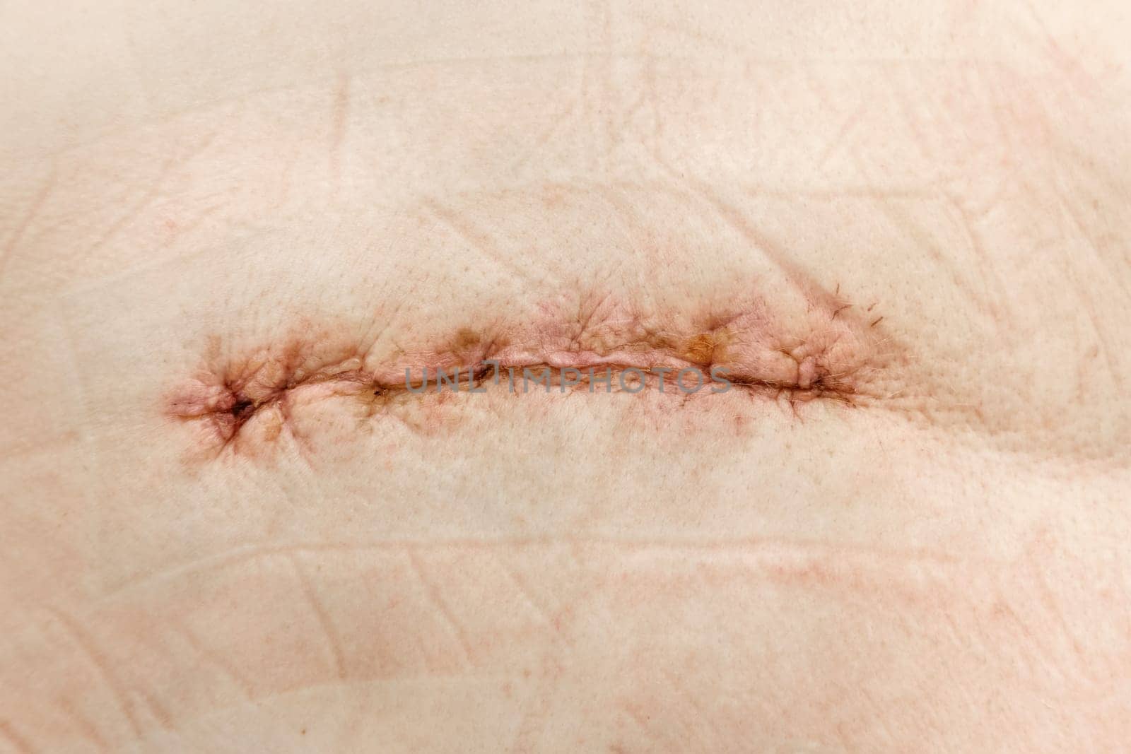 Postoperative healing suture on human skin with slight redness and traces of the plaster