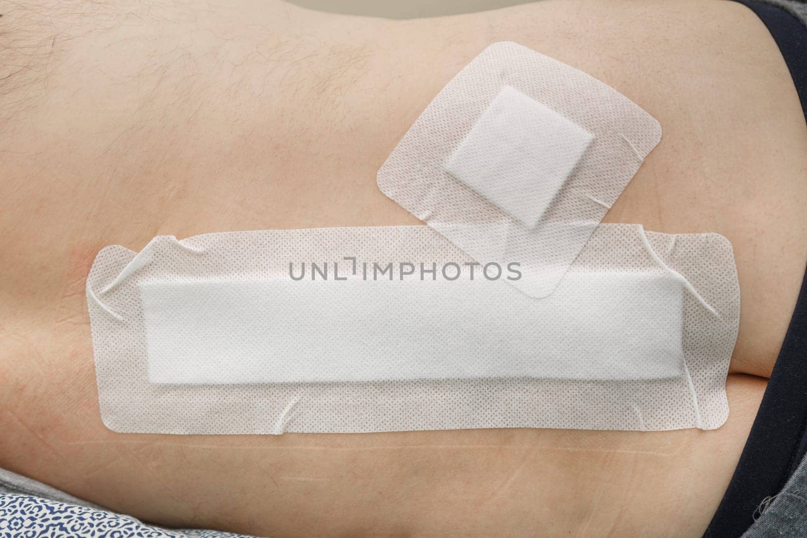 Postoperative suture sealed with a plaster after spinal surgery
