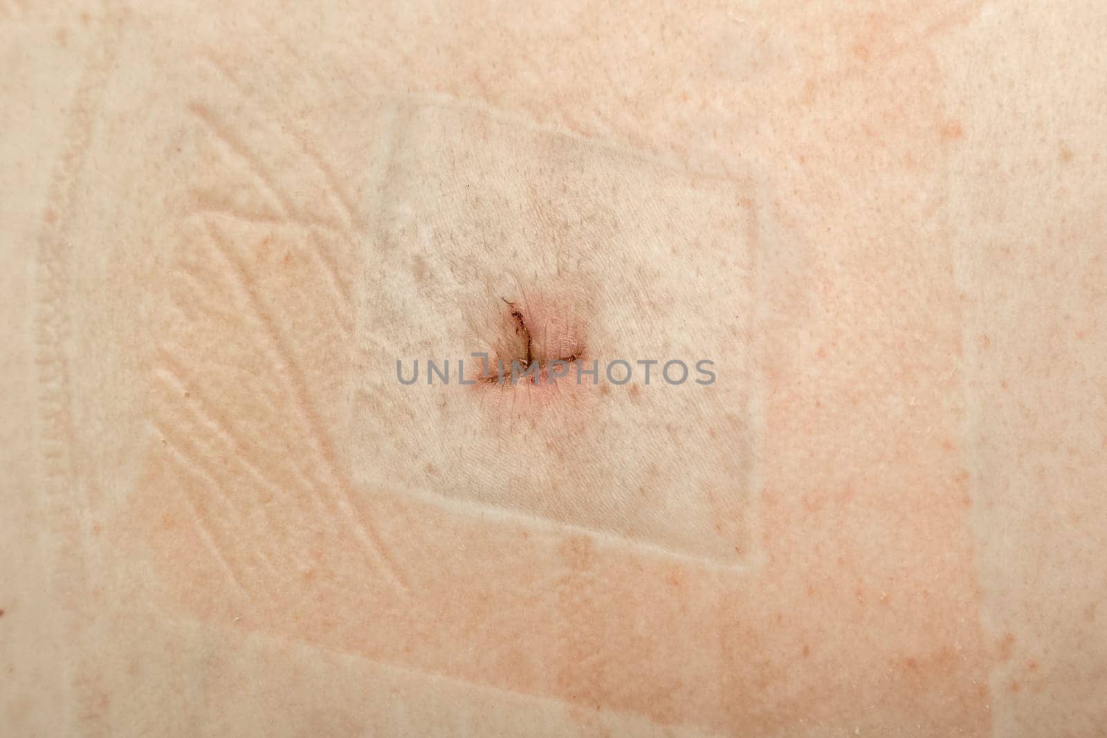 Healing suture scar after small surgery on human skin