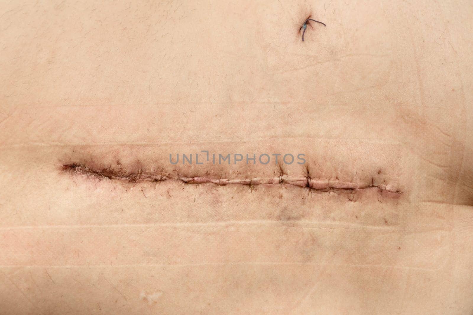 Surgery on the hip. Postoperative suture on the skin with iodine. Un Stitched up skin after an operation