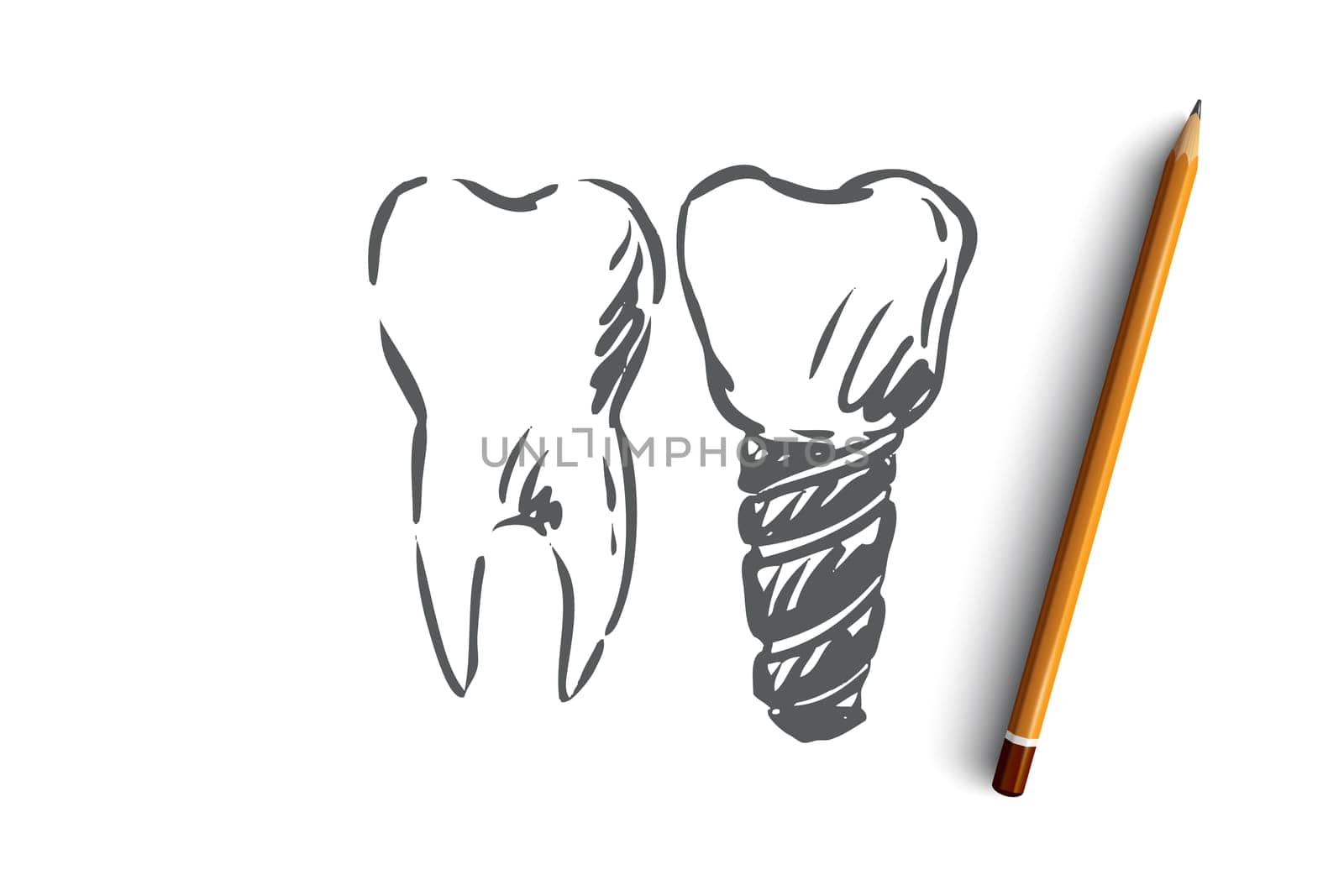 Implant, dental, tooth, health, care concept. Hand drawn healthy tooth and implant concept sketch. Isolated vector illustration.
