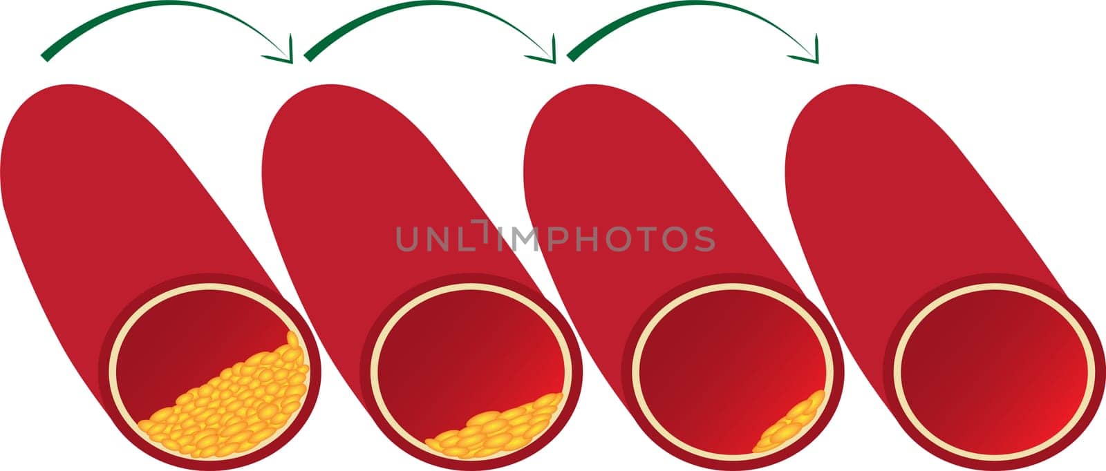 Clean up and redusing vessel blood from atherosclerotic plaque vector illustration