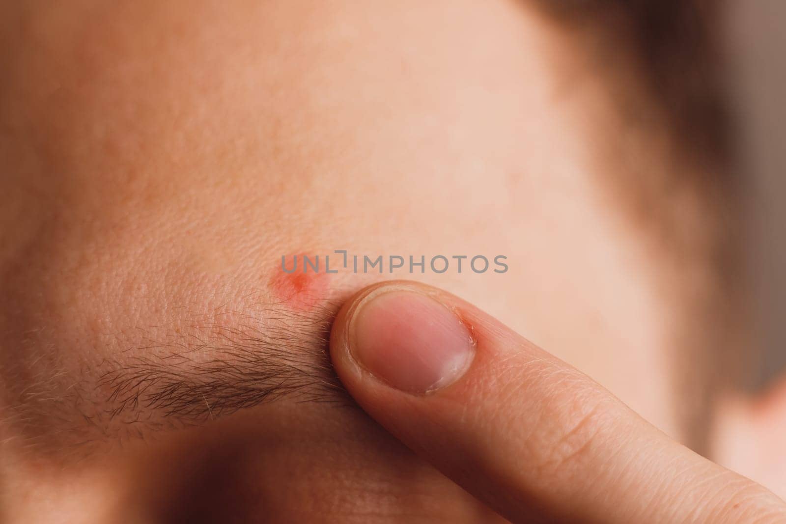 Pimple on the man's forehead above eyebrow. Designated by color close-up