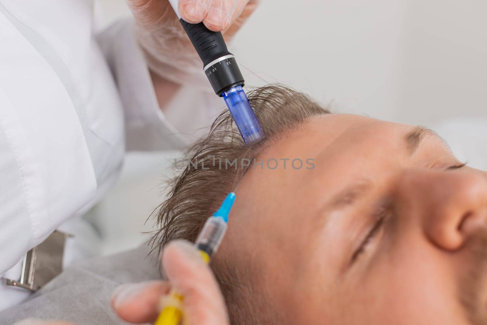 Alopecia. Man hair loss improve growth treatment regeneration, dermapen microneedling vitamin exosomes syringe injections. Trichologist cosmetologist doctor head scalp procedure fractional mesotherapy