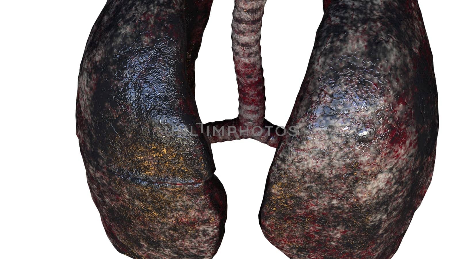 Respiratory organs darkened from resins with 3d render unhealthy spots. Anatomical trachea affected by cancer with diseased pleura leaking viruses. Bad habit symbol with realistic design.