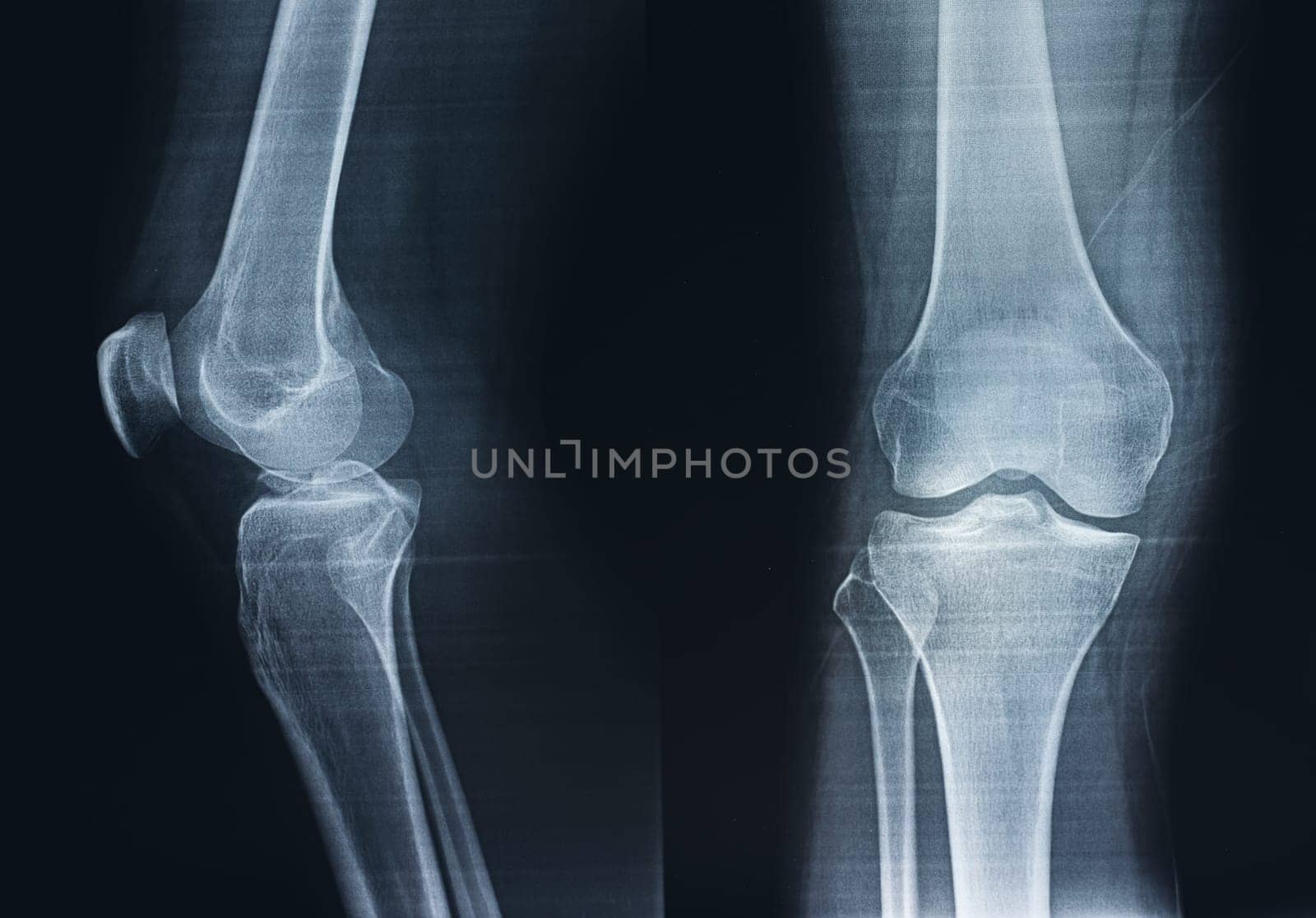 Film X-ray of a leg bone person, Film grain style