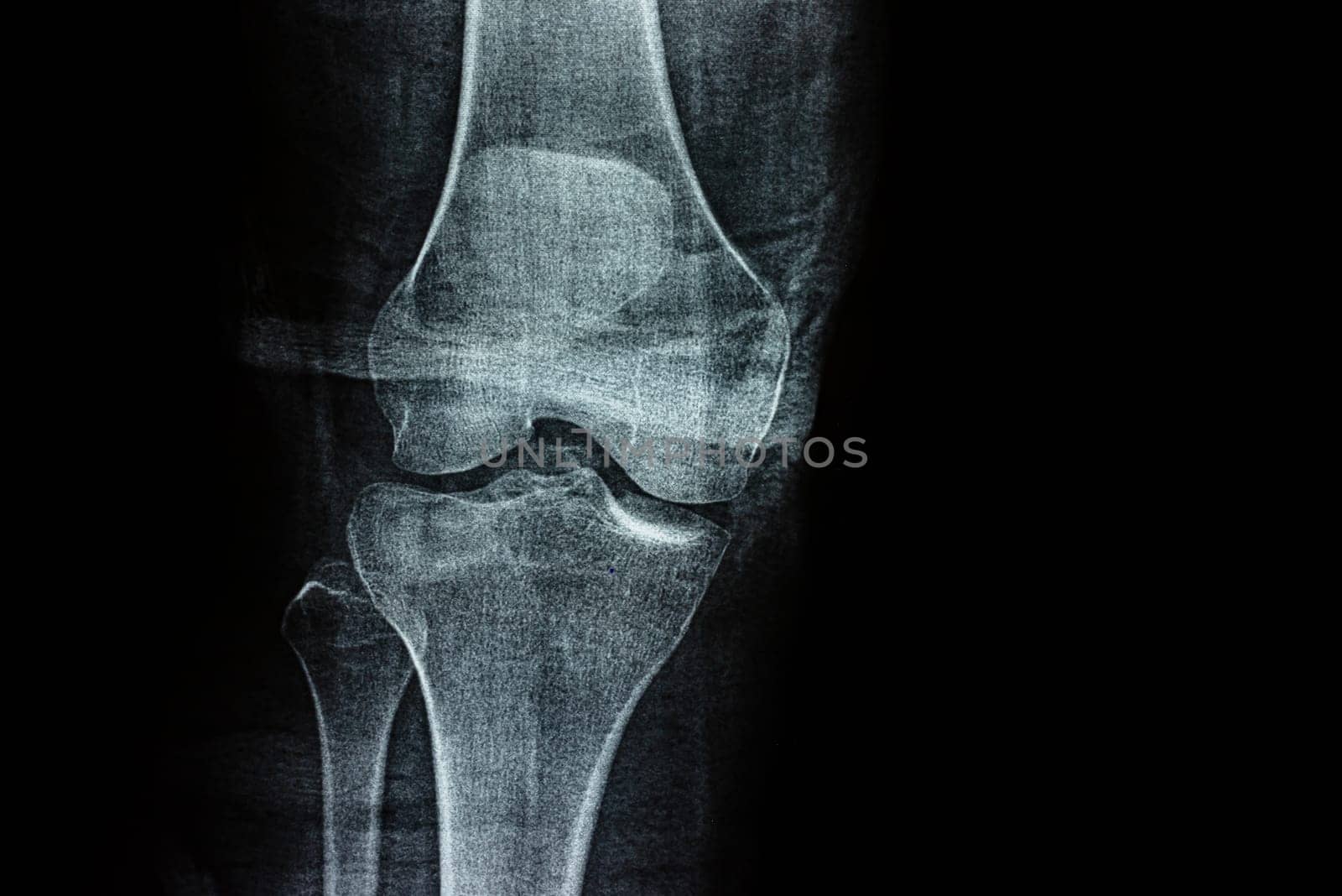 Film X-ray of a leg bone person, Film grain style
