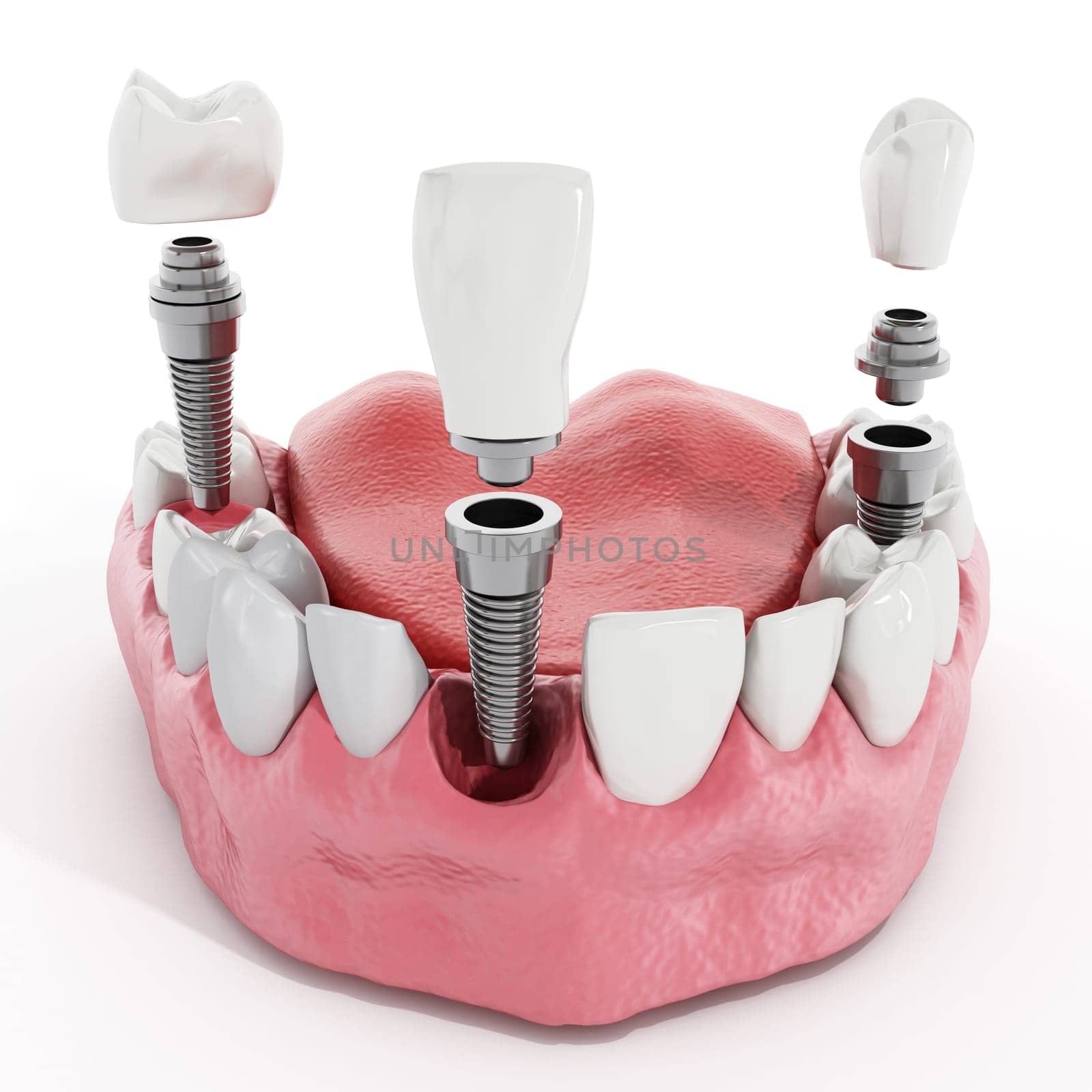 Illustration of teeth showing dental implant structure