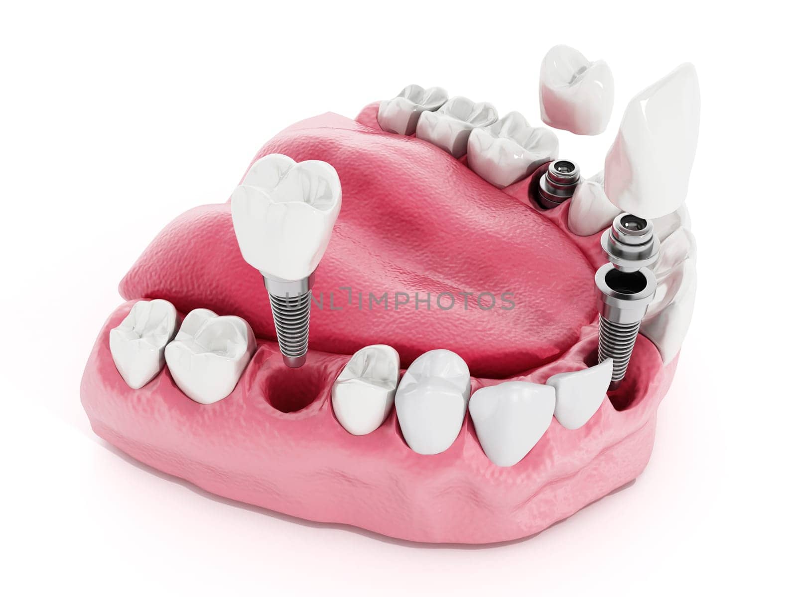 Illustration of teeth showing dental implant structure