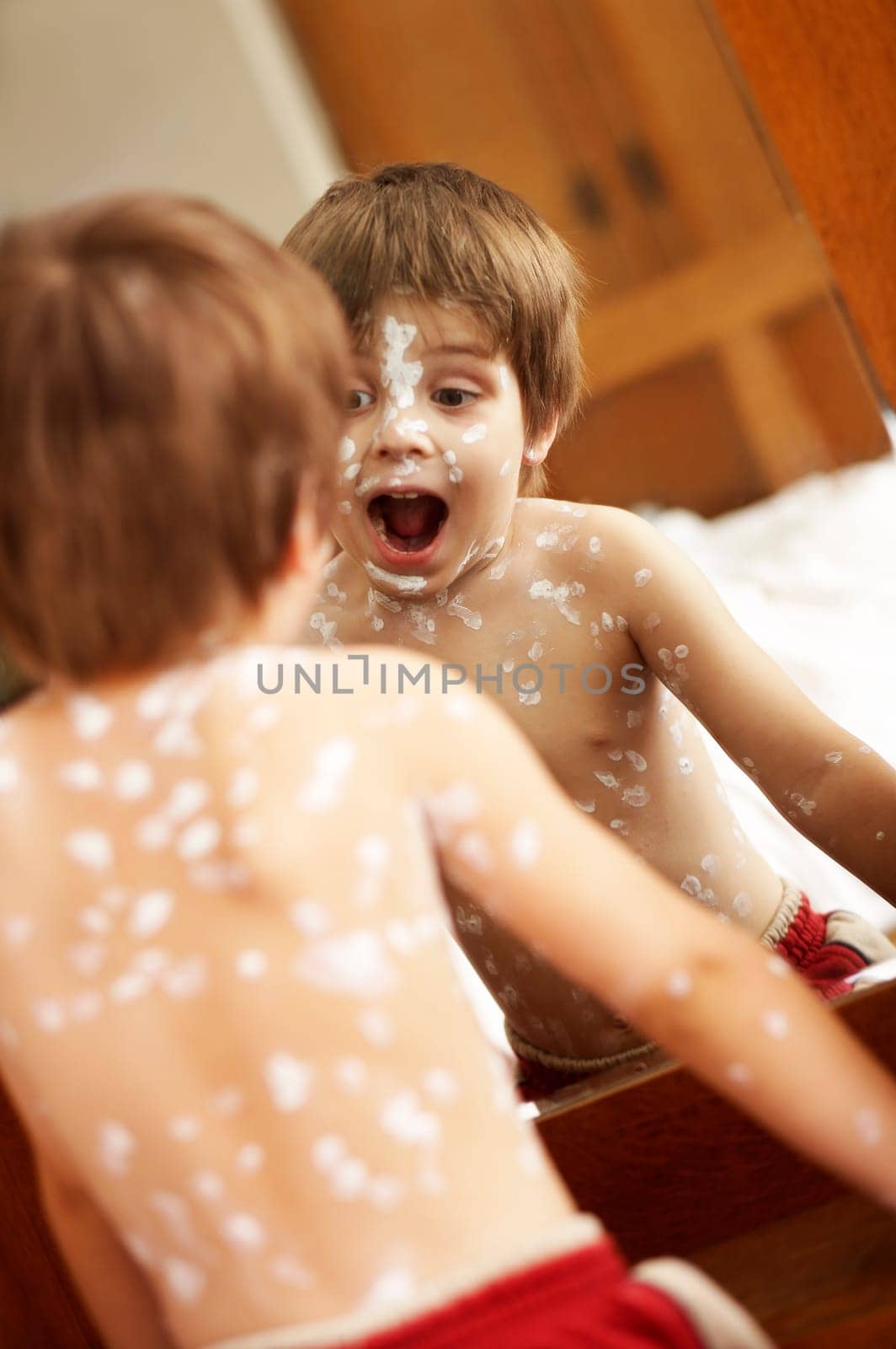 Chickenpox III.