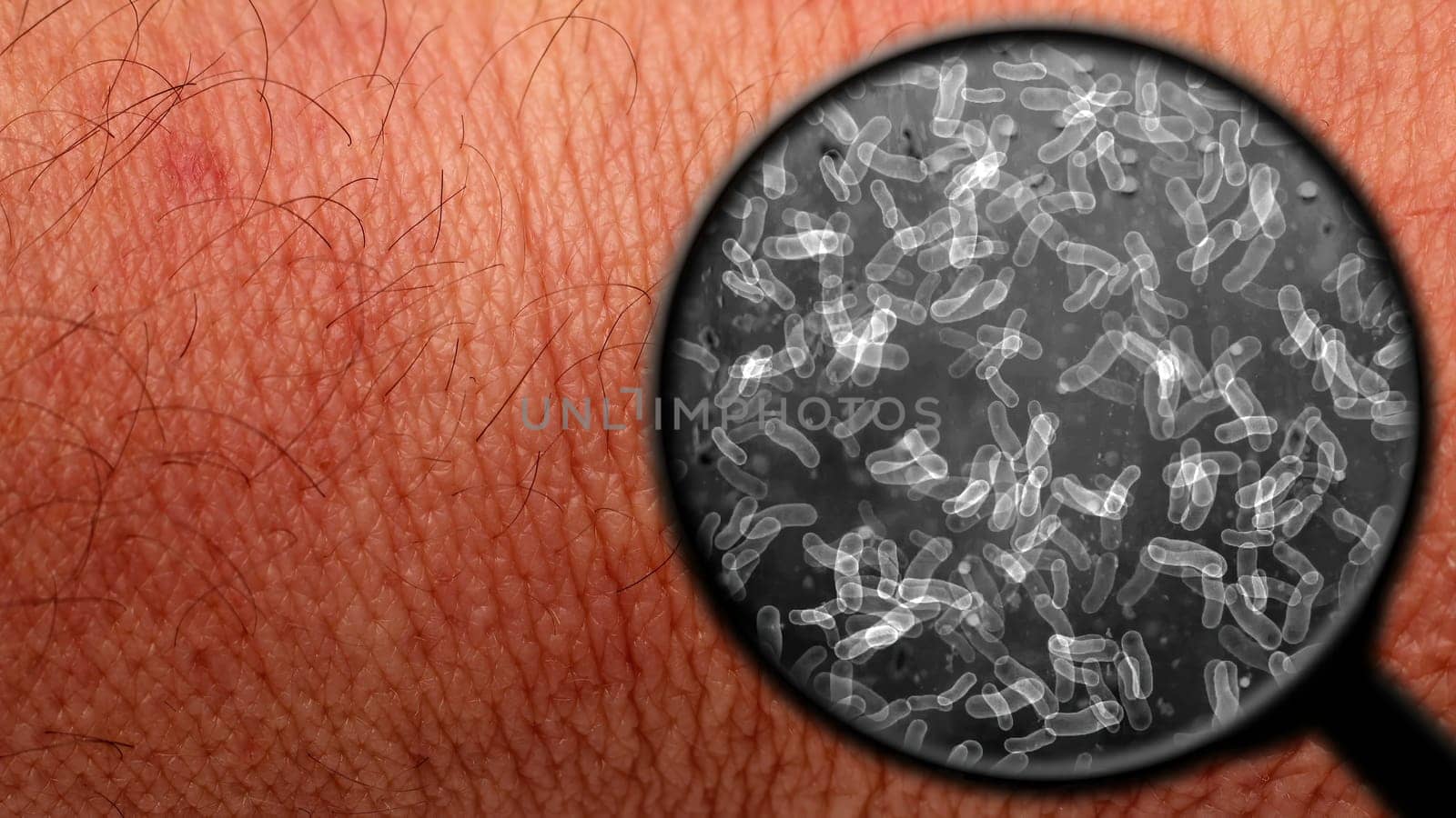 Searching for bacteria on human skin,Searching for bacteria on human skin
