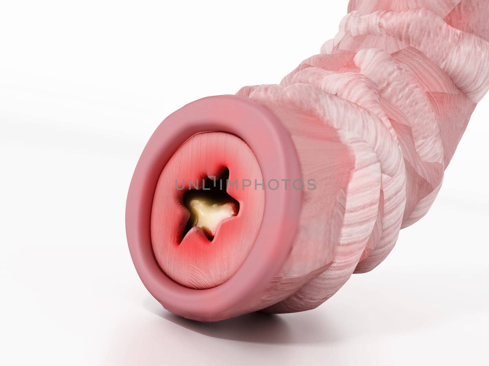 Obstructed bronchial tube illustration representing asthma. 3D illustration.