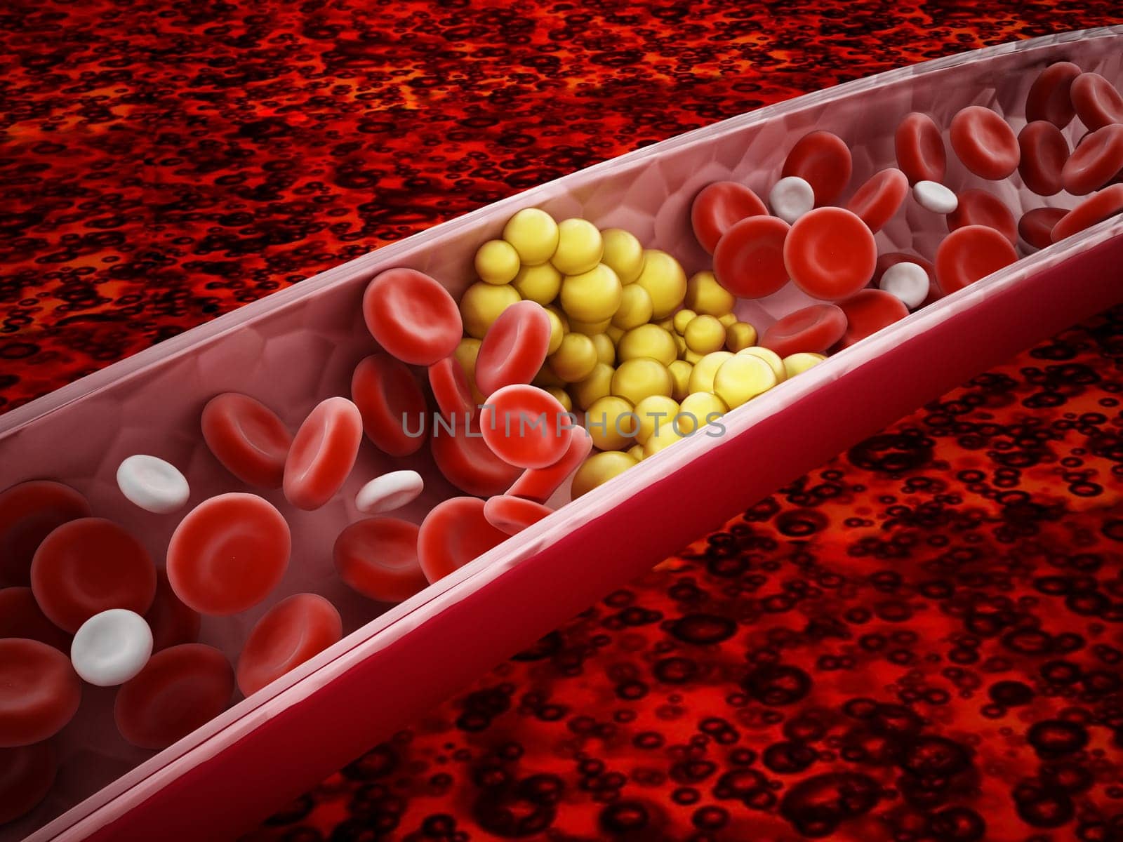 Fat cells blocking the blood flow inside human vein. 3D illustration.
