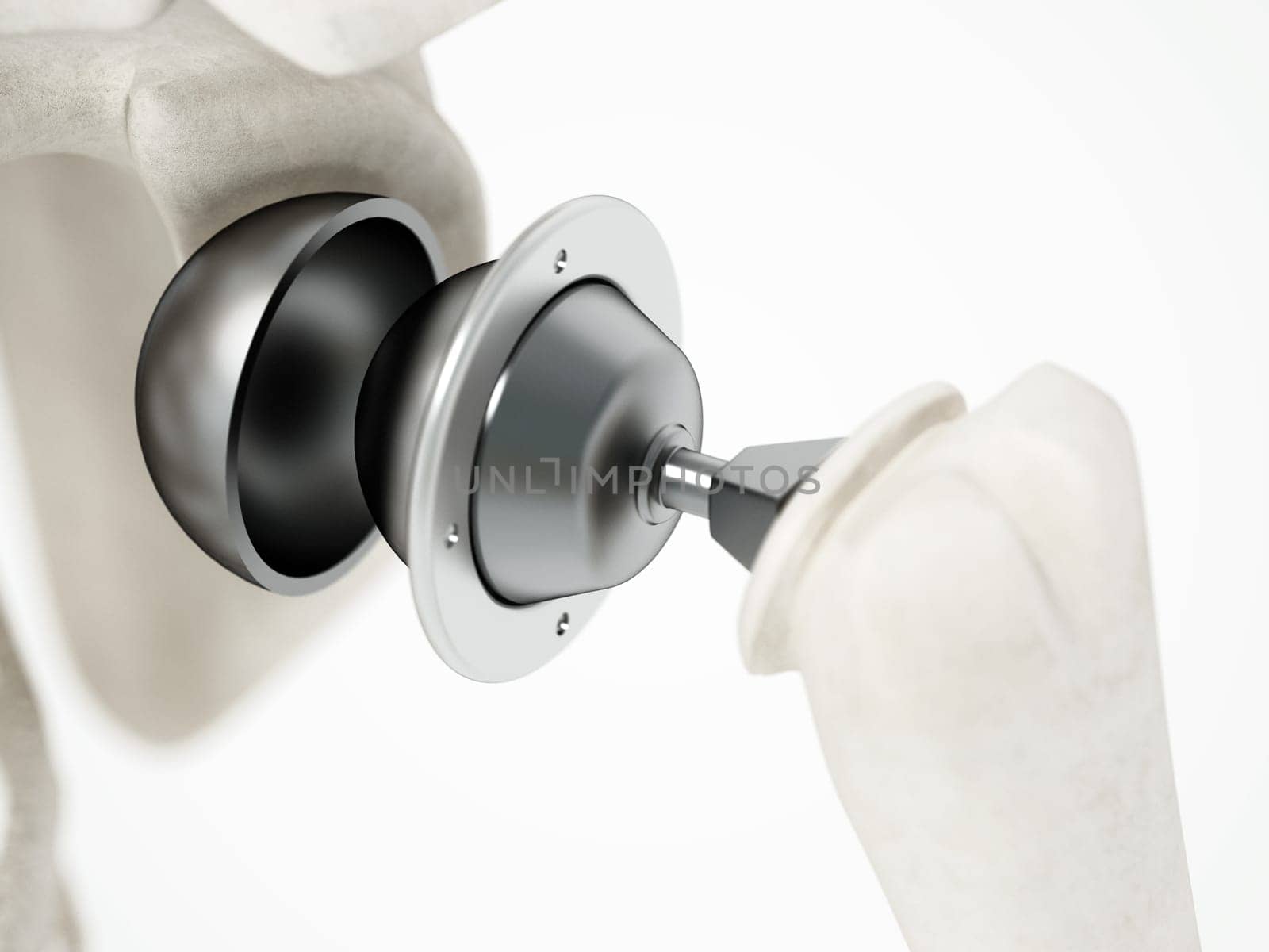 3D illustration of shoulder replacement surgery. 3D illustration.
