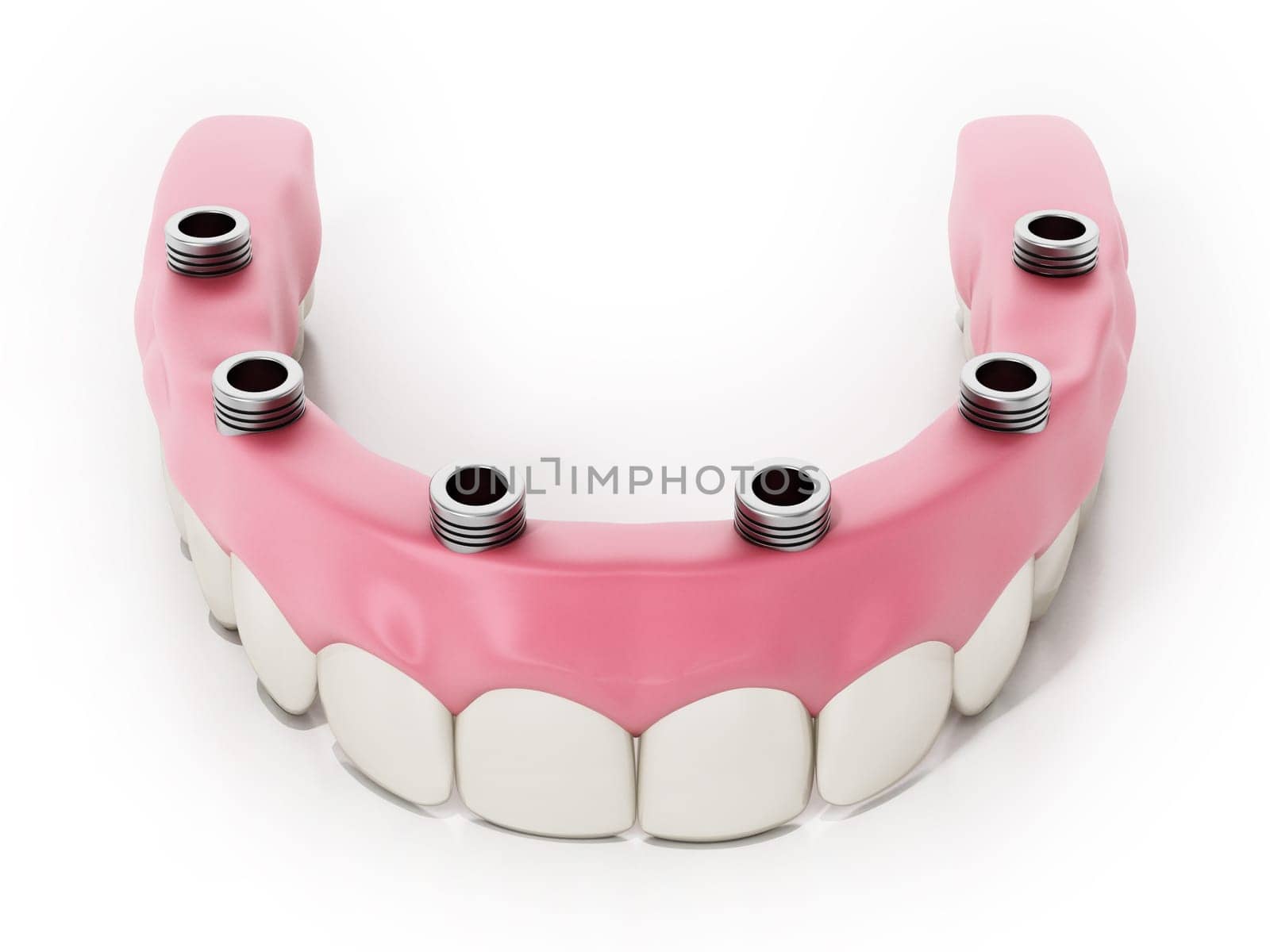 Dental prosthesis isolated on white background. 3D illustration.