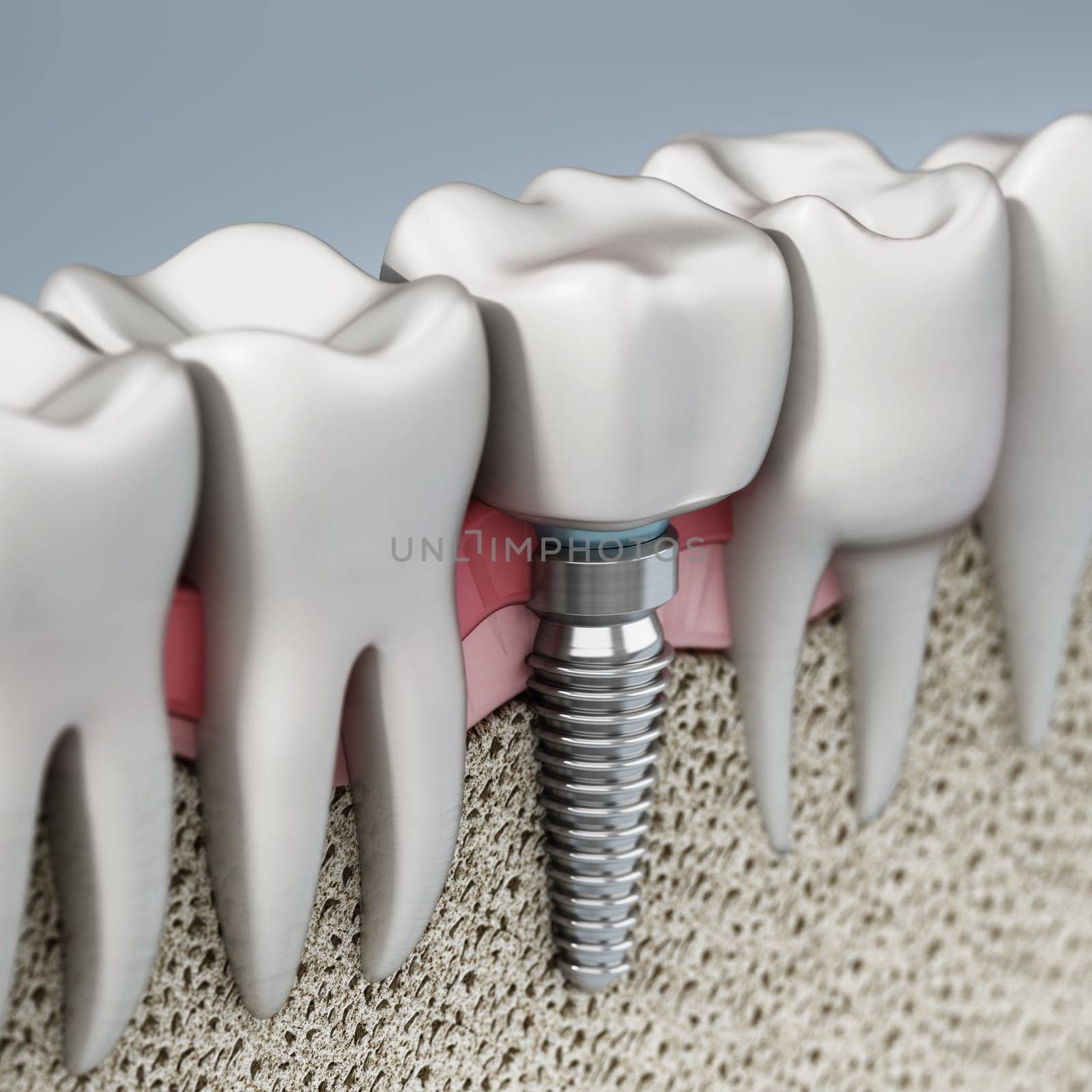 3D rendering of tooth implant showing jaw gum and bone layers. 3D illustration.