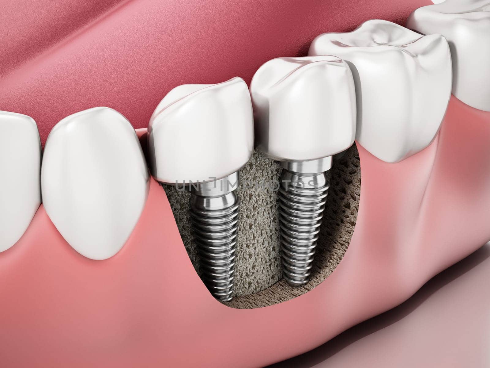3D illustration of two dental implants on the lower jaw.