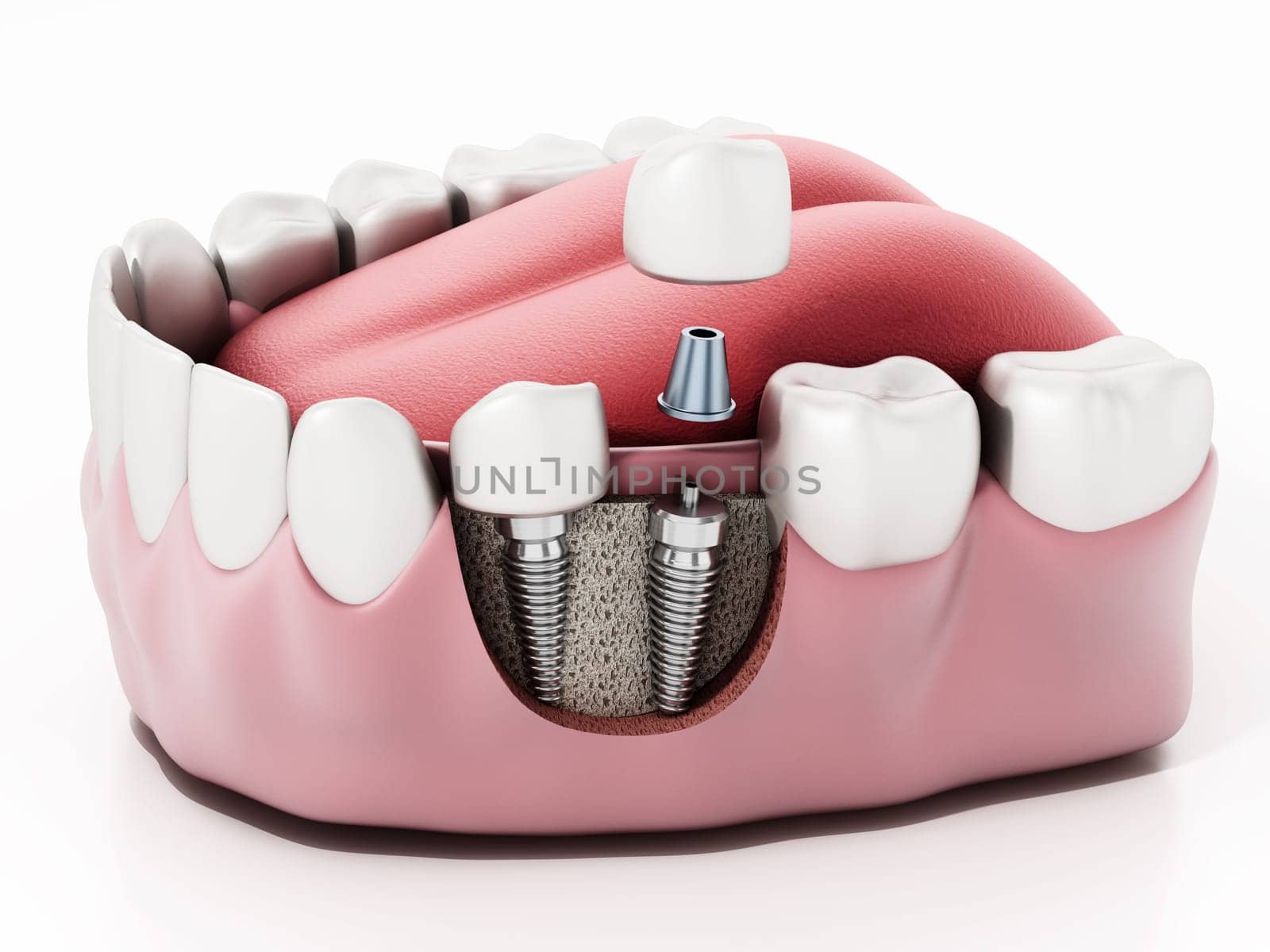 3D illustration of two dental implants on the lower jaw.