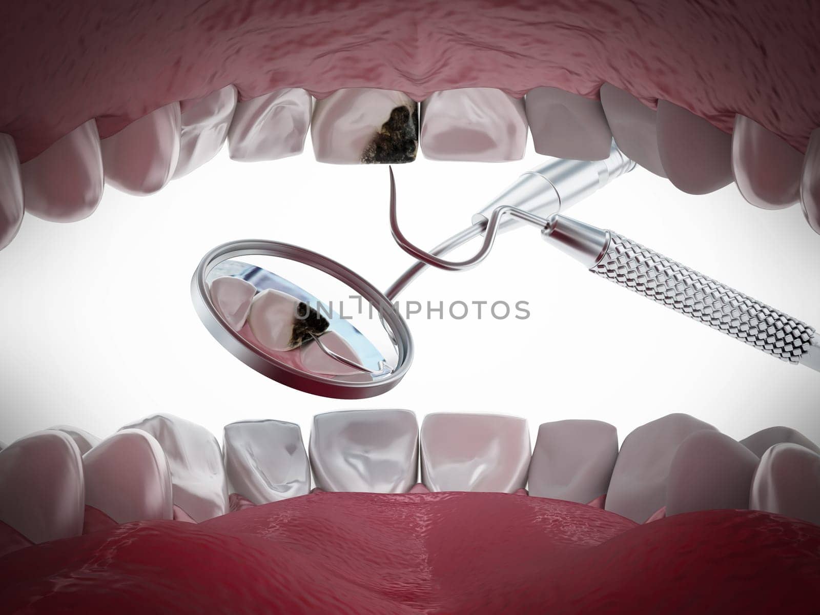 Decayed tooth diagnosis and treatment. 3D illustration.