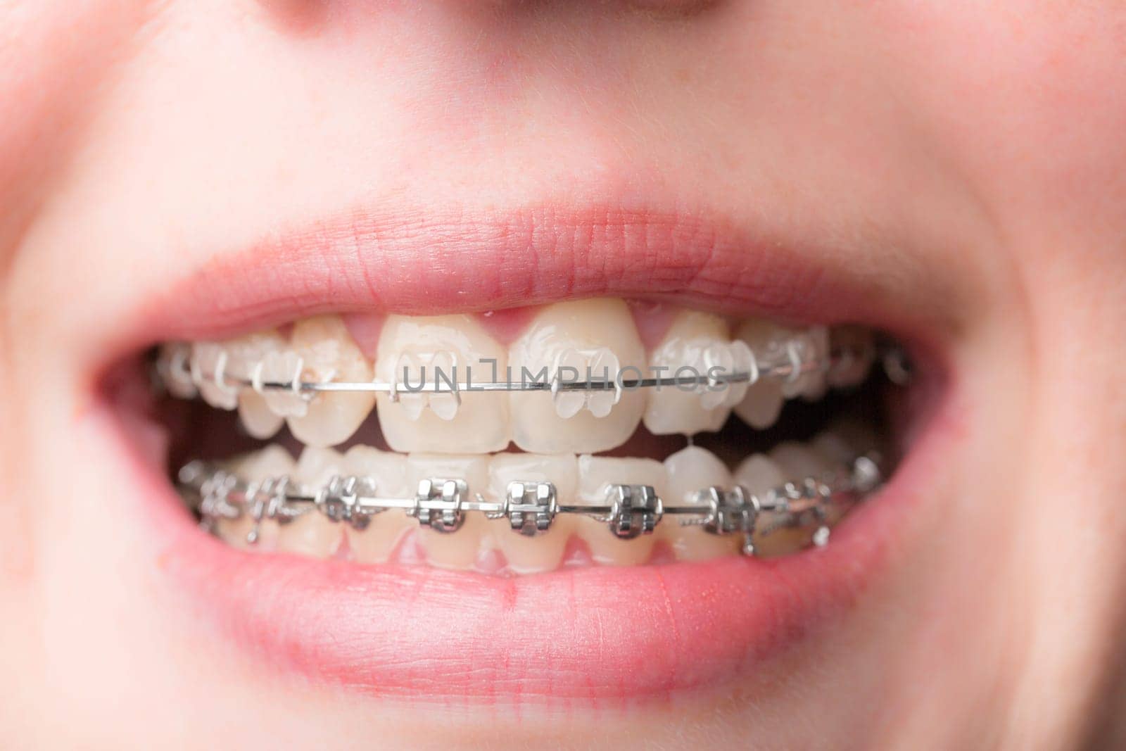 close-up of a female teenager's mouth with a dental brace