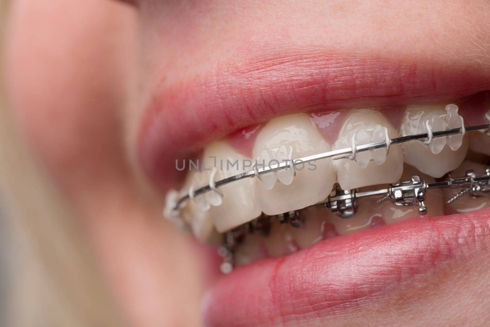 close-up of a female teenager's mouth with a dental brace