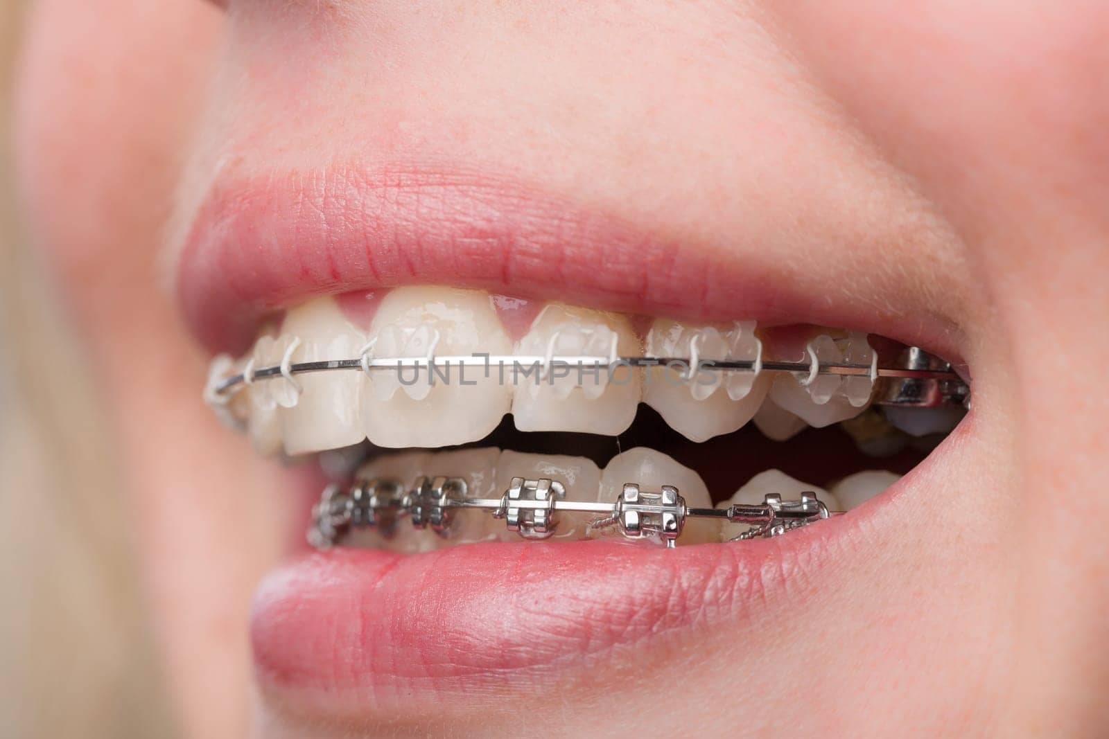 close-up of a female teenager's mouth with a dental brace