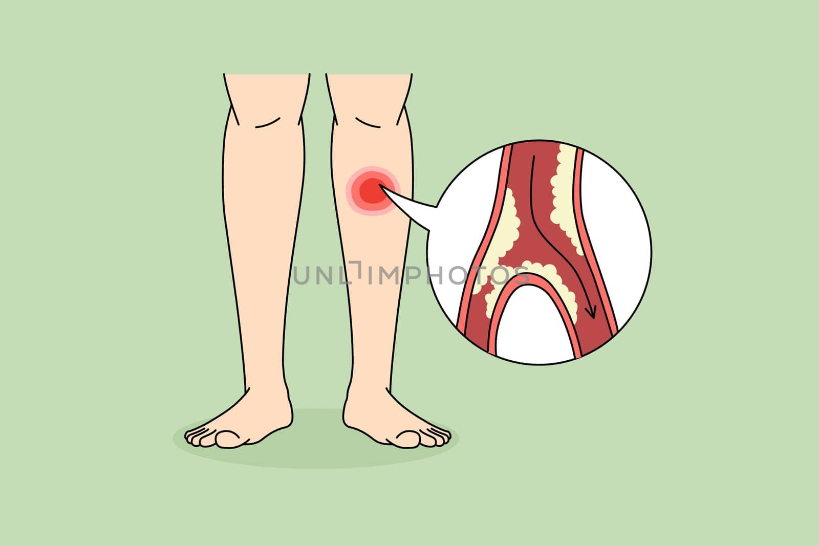 Close up of person suffer from PAD disease having blood vessel blockage in legs. Man struggle with clotted limbs from veins narrowing or blocking. Healthcare concept. Vector illustration.