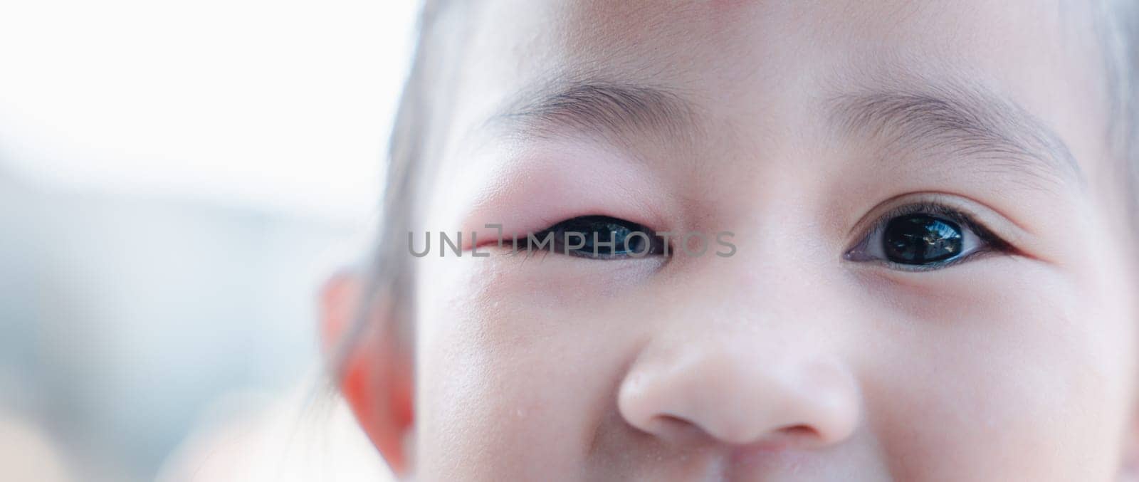 Stye Eye diseases. Closed Asian kid little girl eye with sty, eyelid abscess ophthalmic hordeolum