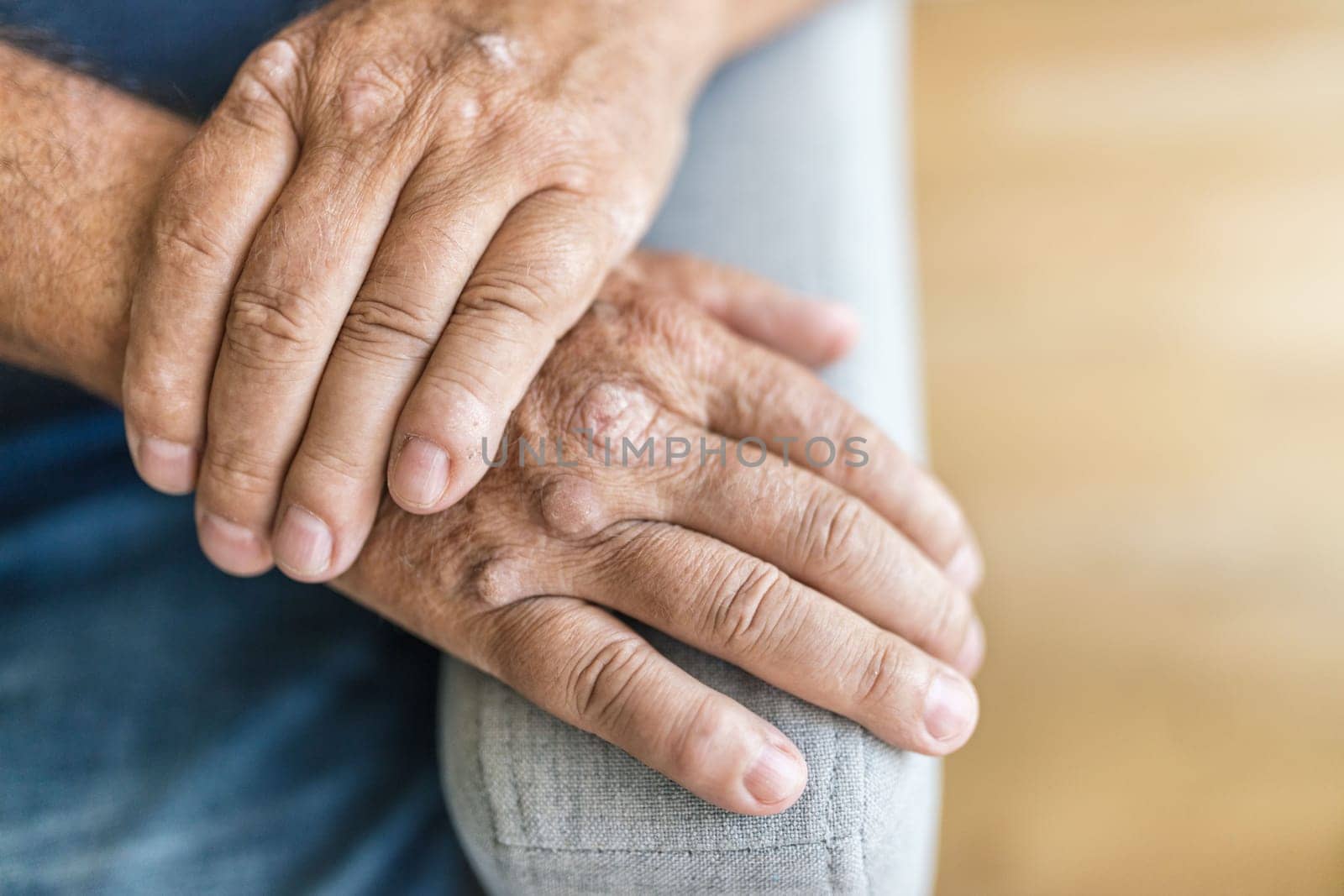 Elderly man suffering from psoriasis, closeup on hands