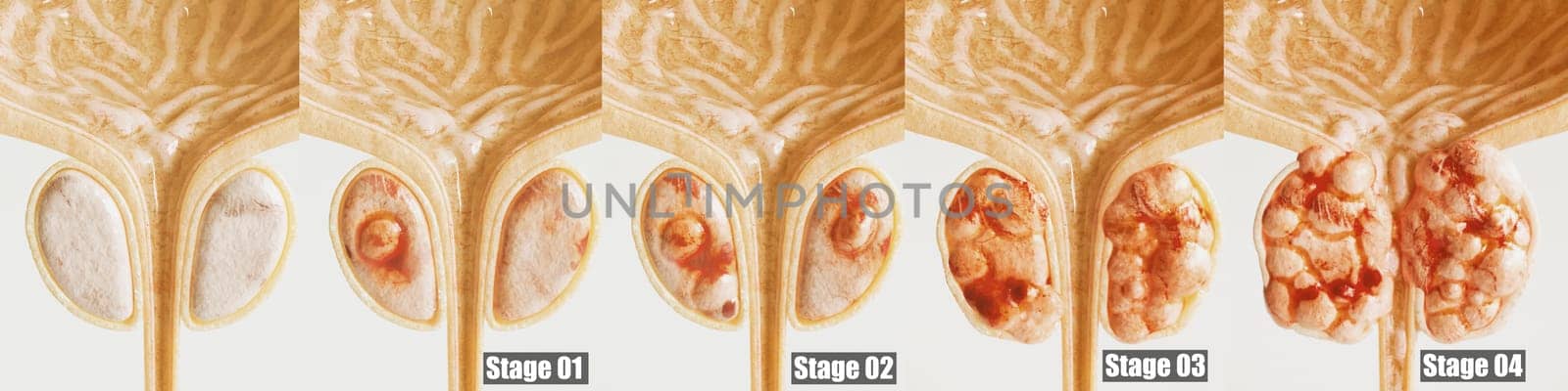 Prostate cancer all 4 stages - detailed close-up - High quality 3d Rendering