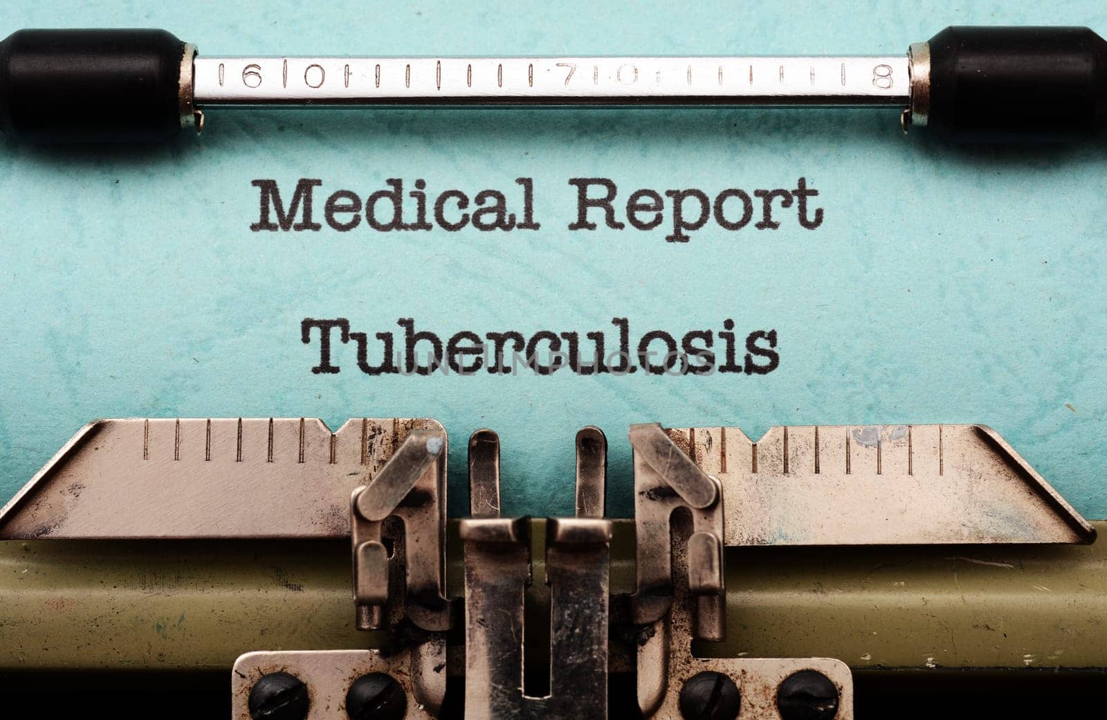 Tuberculosis