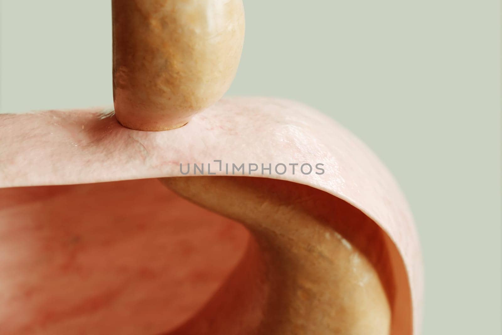 Axial hiatus hernia type 1 - entrance to the stomach via the diaphragm -- 3D rendering