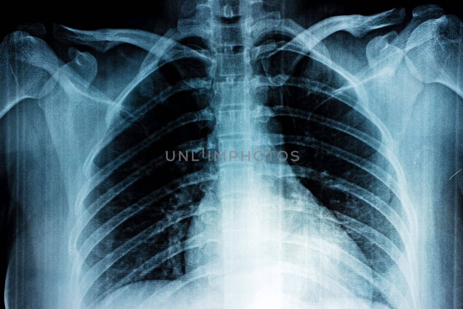 Film X-ray of breast a person, Film grain style