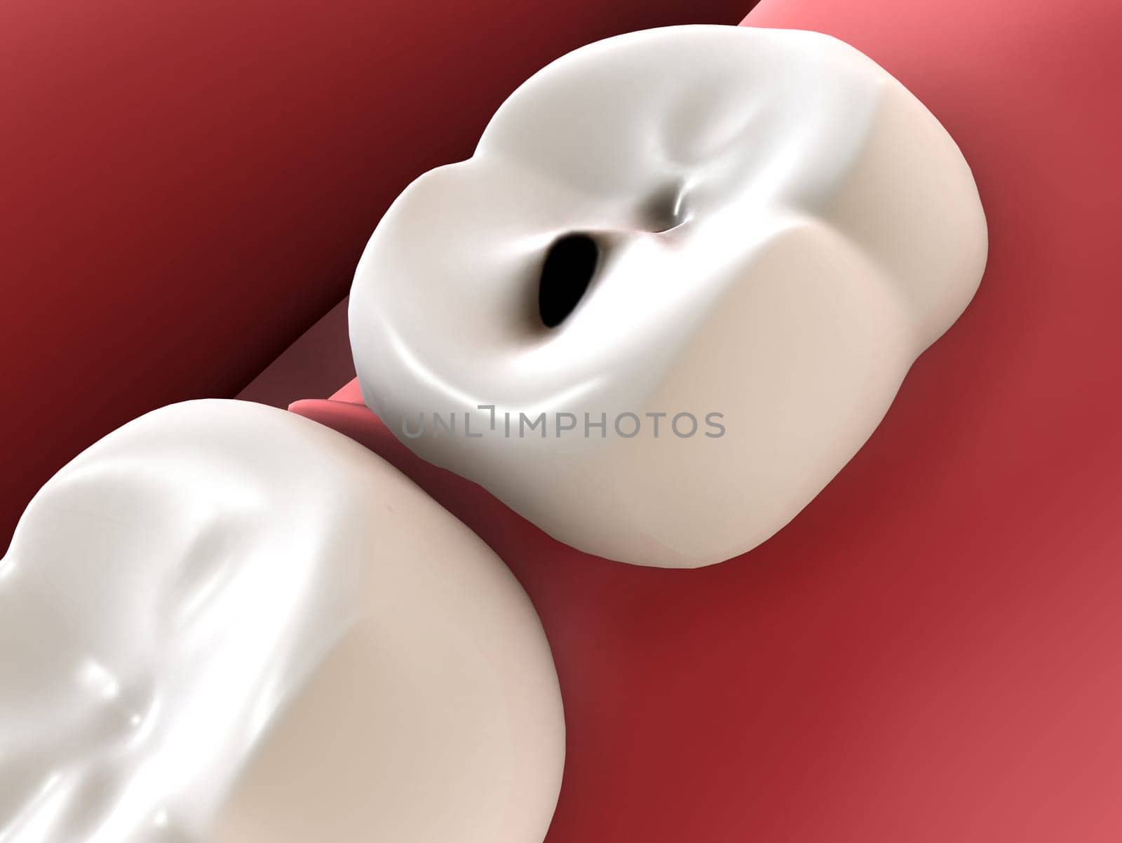 3d rendered illustration of teeth with caries