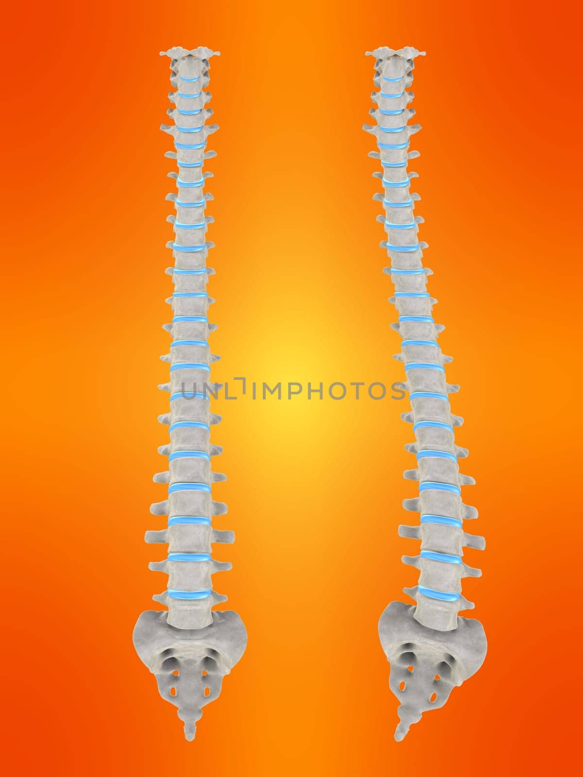 3d rendered anatomy illustration of a human spine with scoliosis
