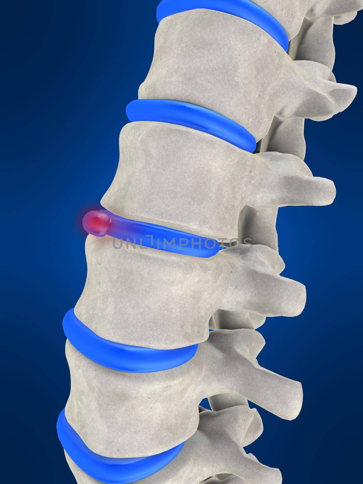 3d rendered illustration from a part of the spine with a slipped disc