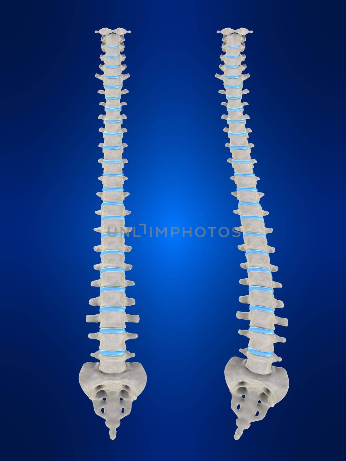 3d rendered anatomy illustration of a human spine with scoliosis