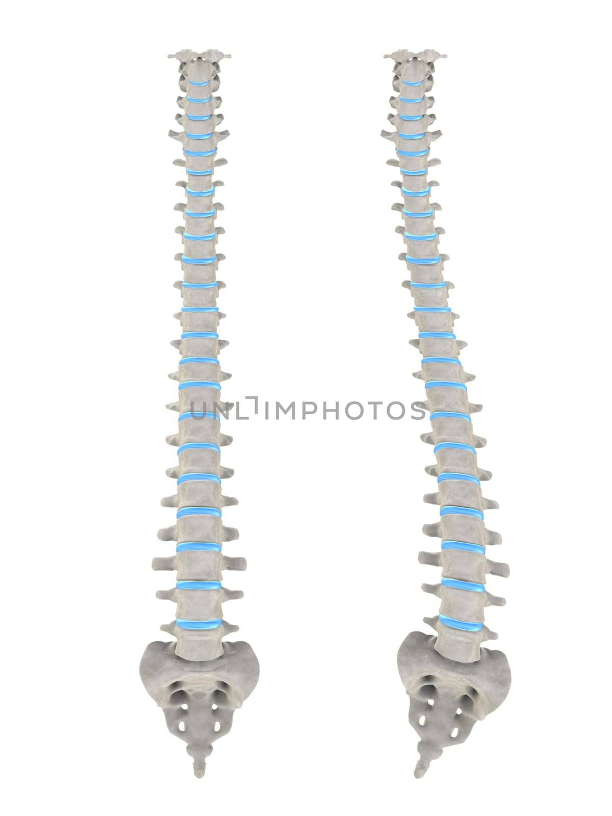 3d rendered anatomy illustration of a human spine with scoliosis