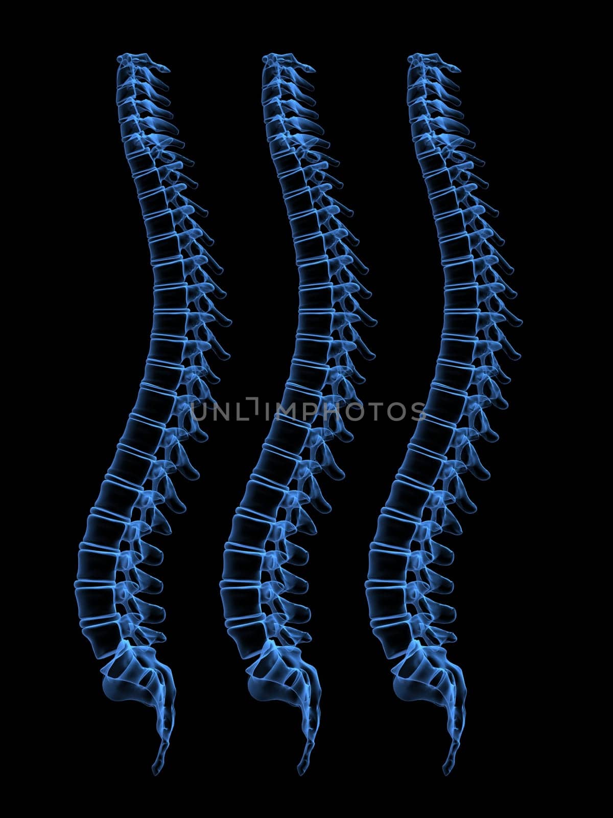 3d x-ray illustration of three human spines