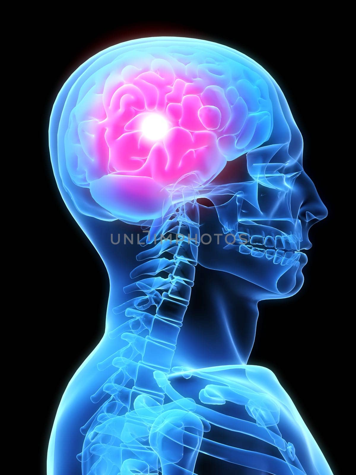 3d rendered illustration of a human x-ray head with pain