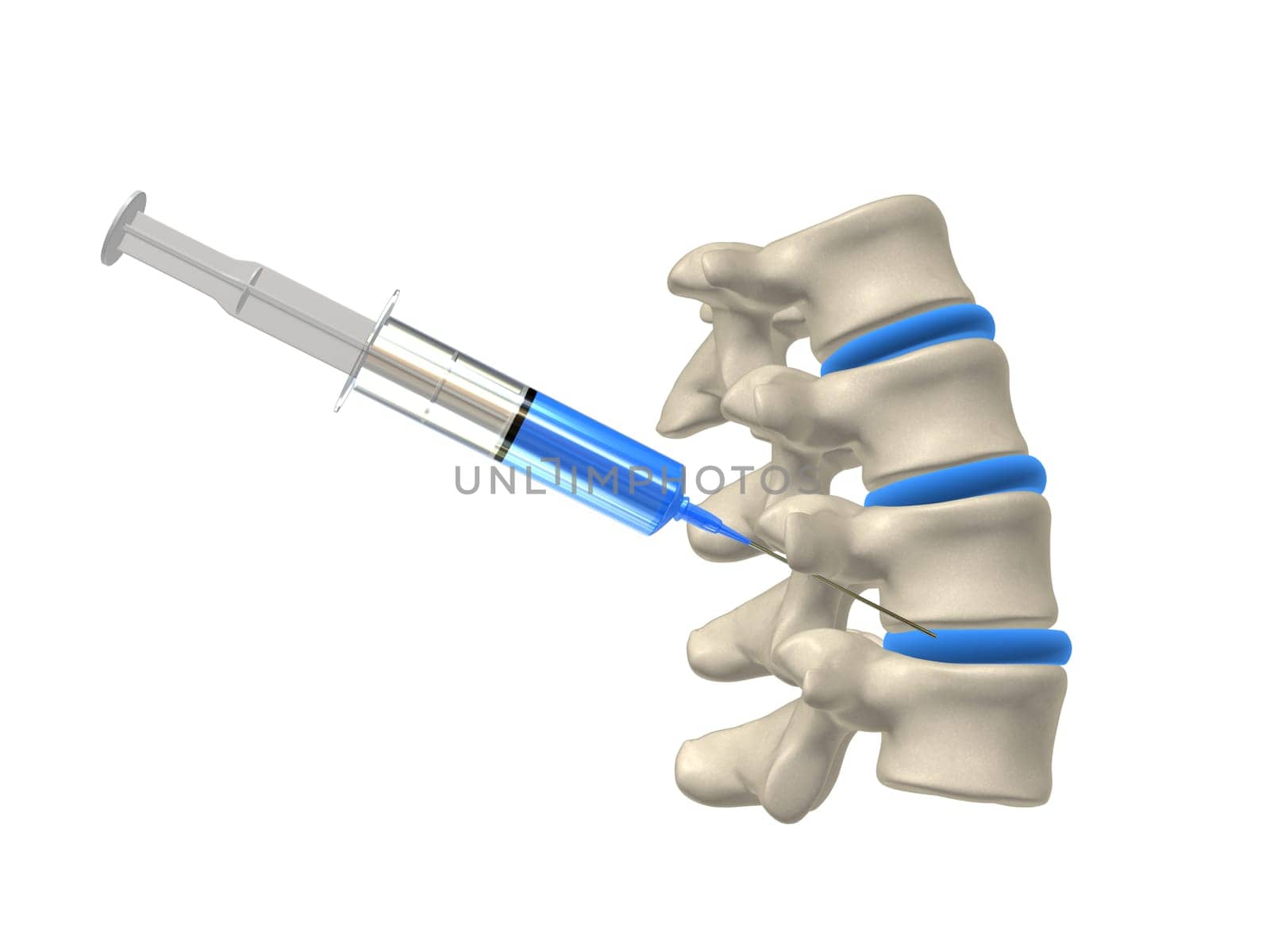 3d rendered anatomy illustration from a part of a spine with an injection