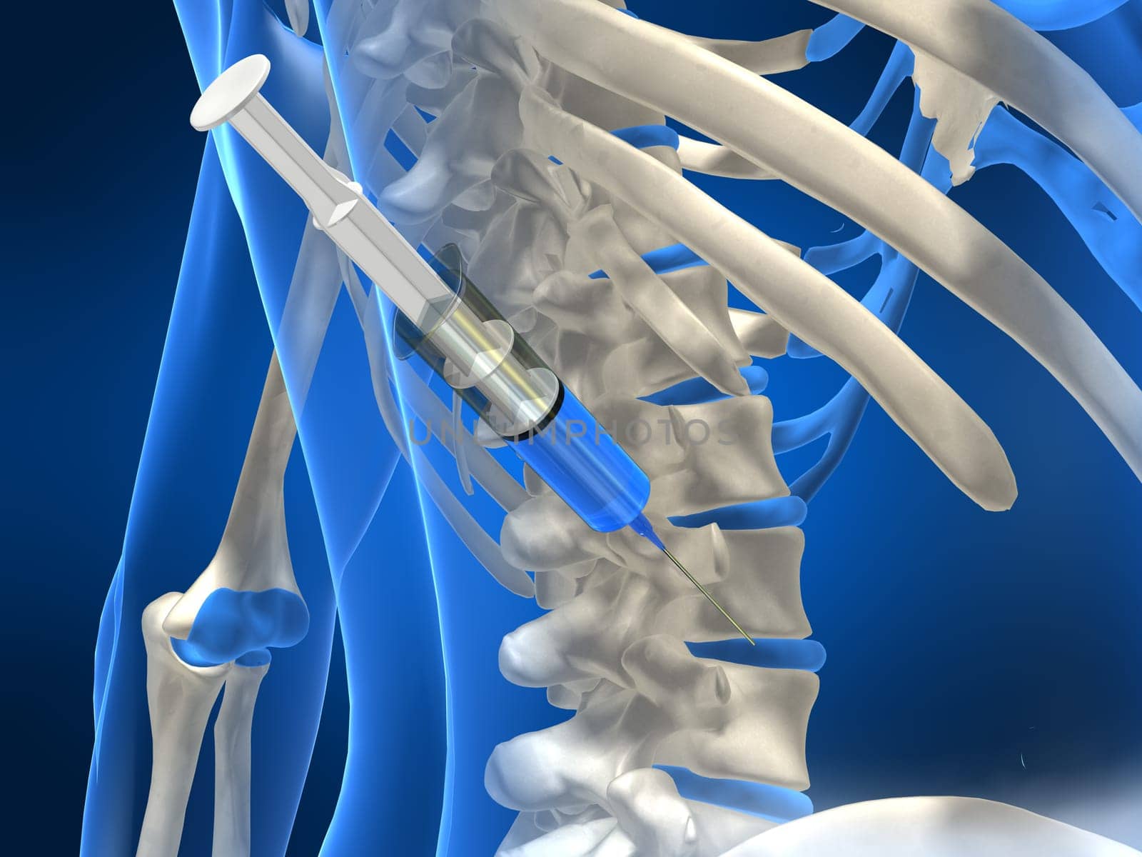 3d rendered anatomy illustration of a human back with an injection