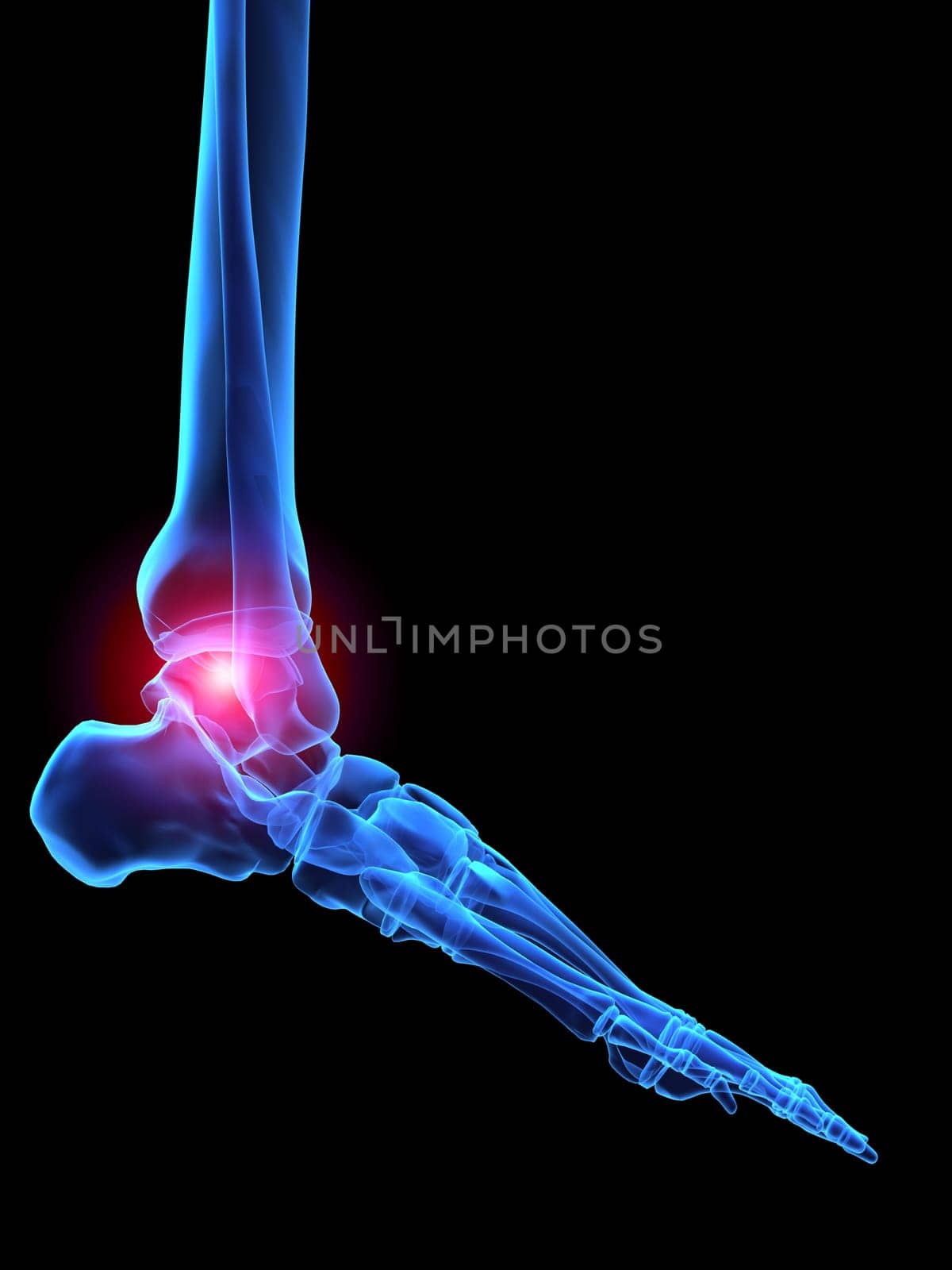 3d rendered x-ray illustration of a human skeletal foot with pain