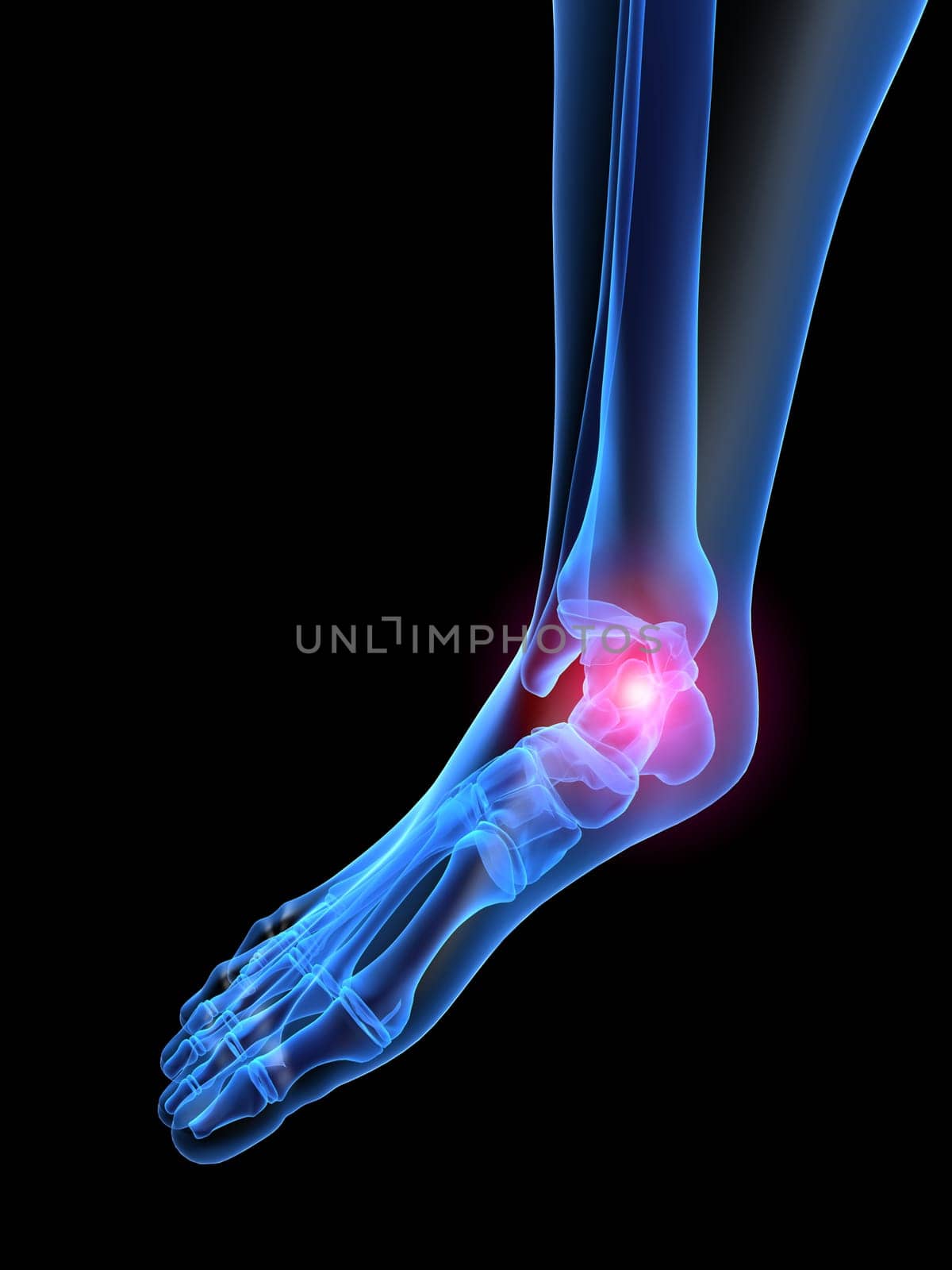 3d rendered x-ray illustration of a human painful foot