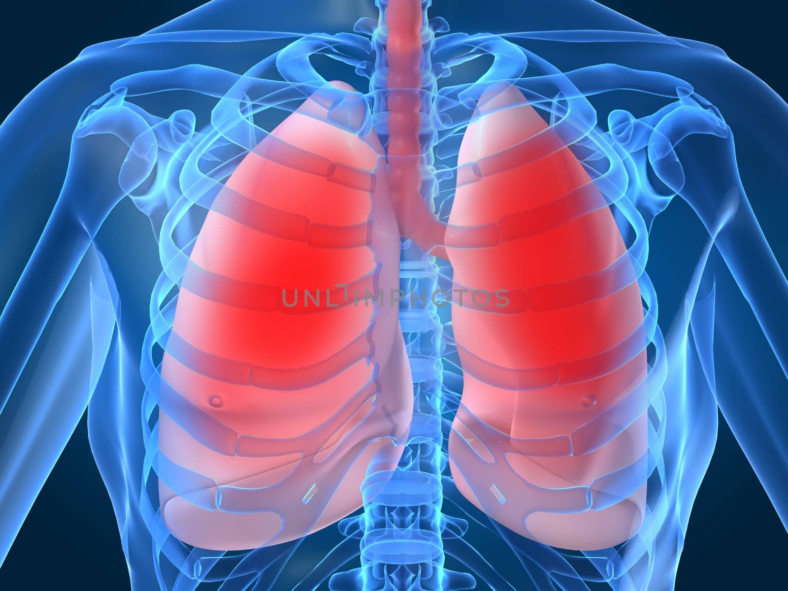 3d rendered anatomy illustration of a human chest with a lung infection