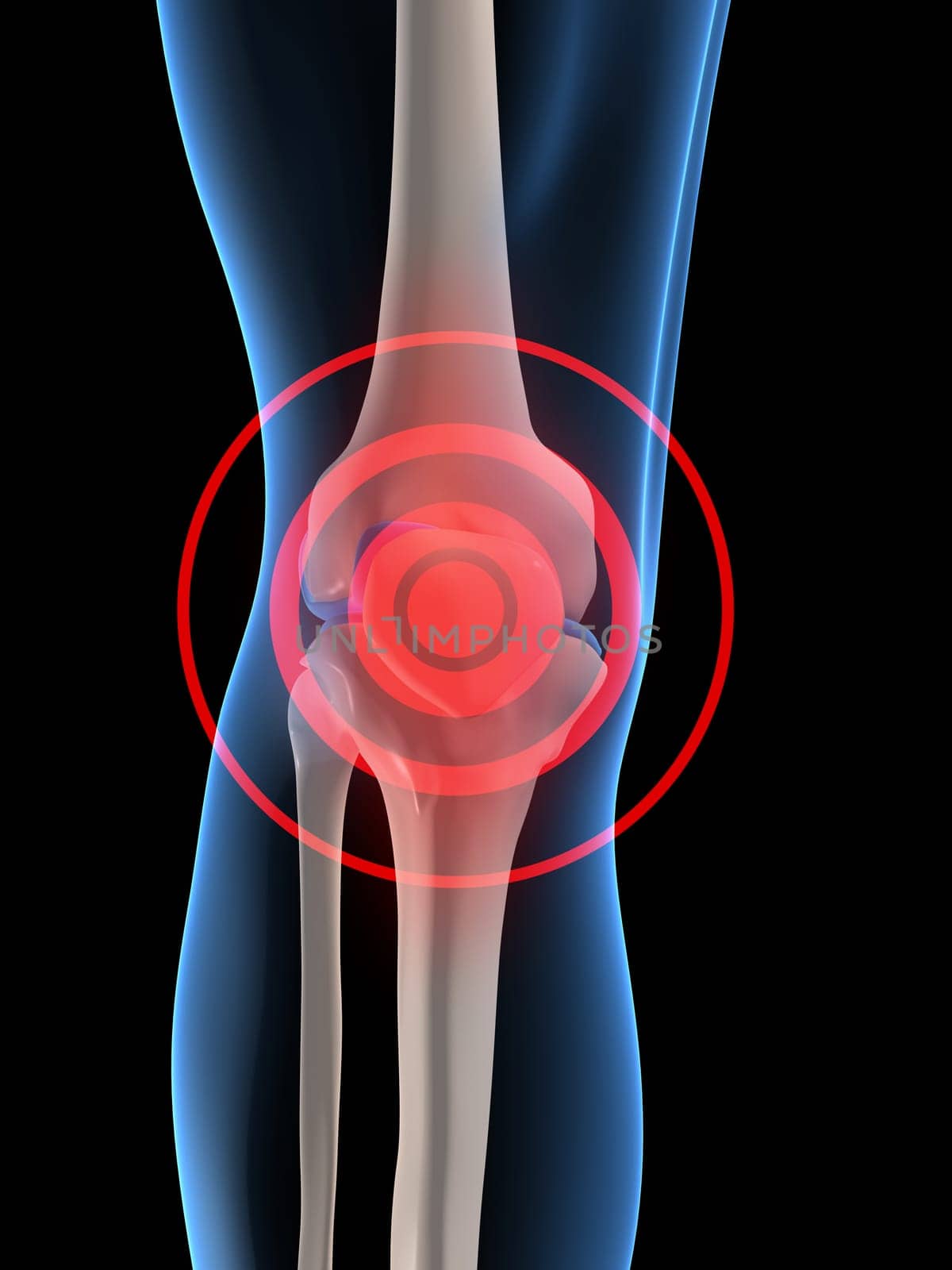 3d rendered anatomy illustration of a human skeletal knee with pain