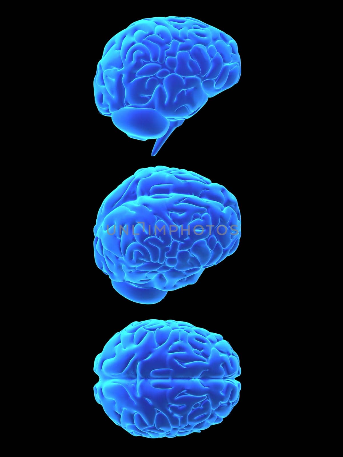 3d rendered anatomy illustration of different signs of a human brain