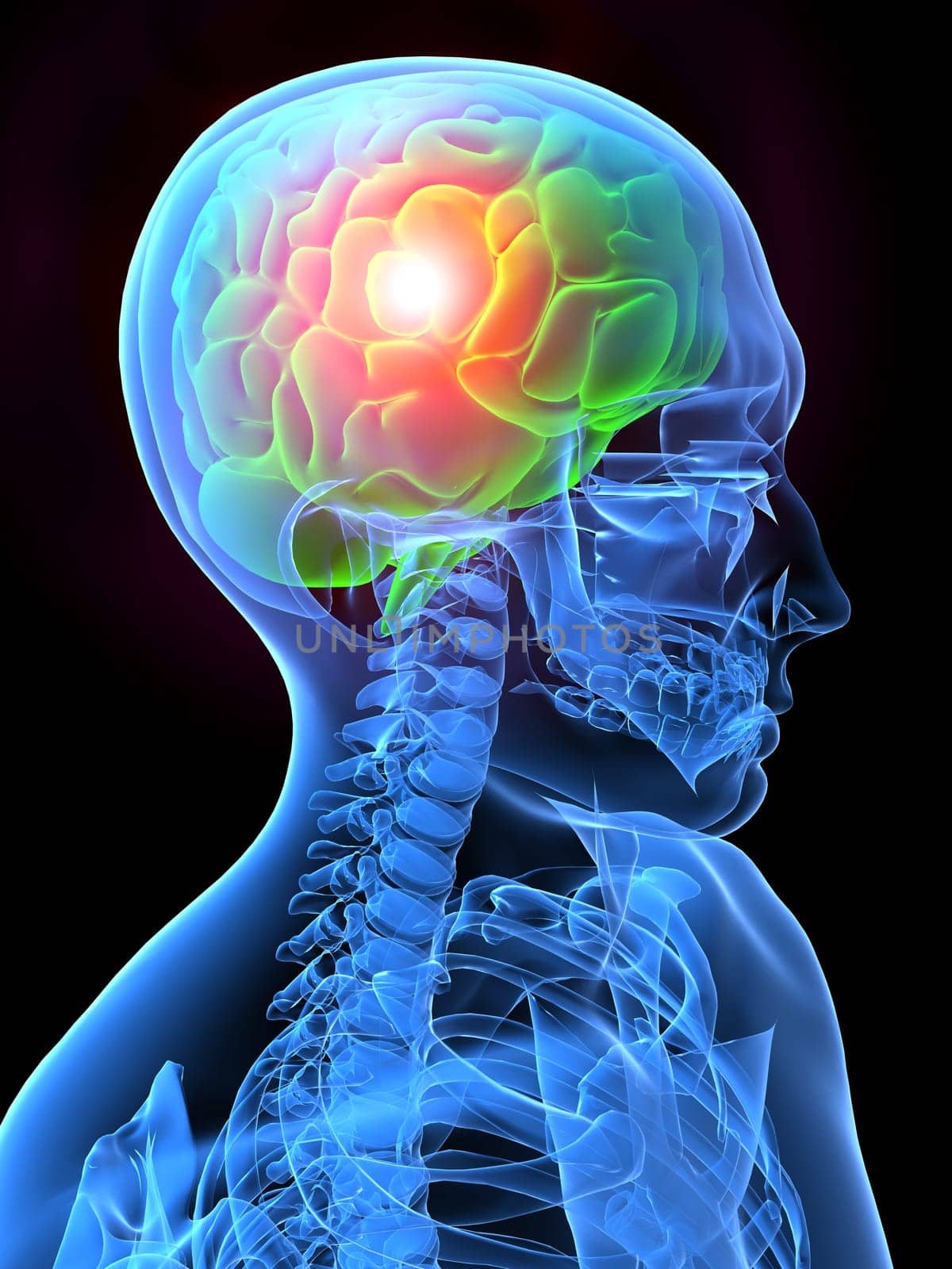 3d rendered x-ray illustration of a human head with pain